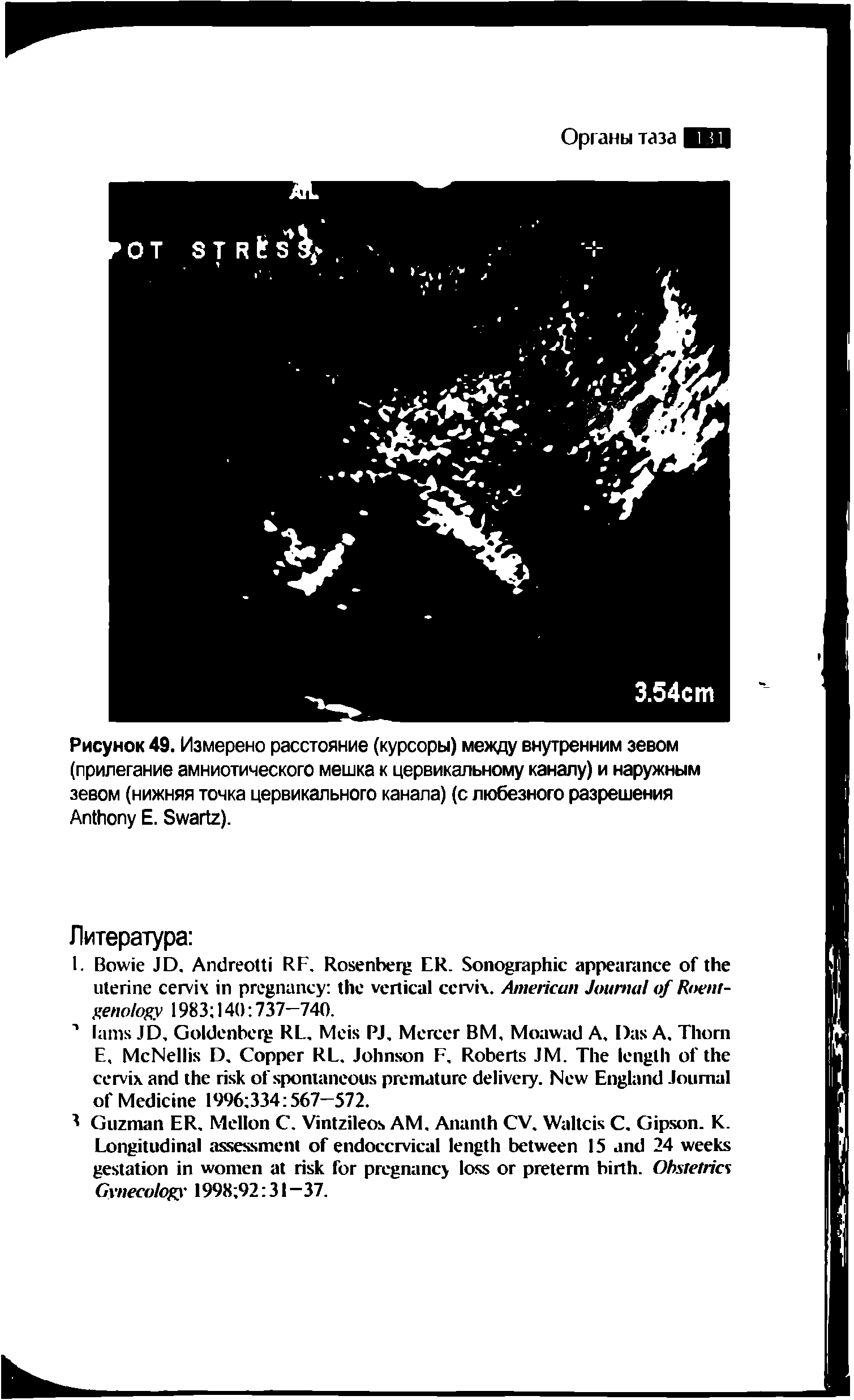 Рисунок 49. Измерено расстояние (курсоры) между внутренним зевом (прилегание амниотического мешка к цервикальному каналу) и наружным зевом (нижняя точка цервикального канала) (с любезного разрешения A Е. S ).