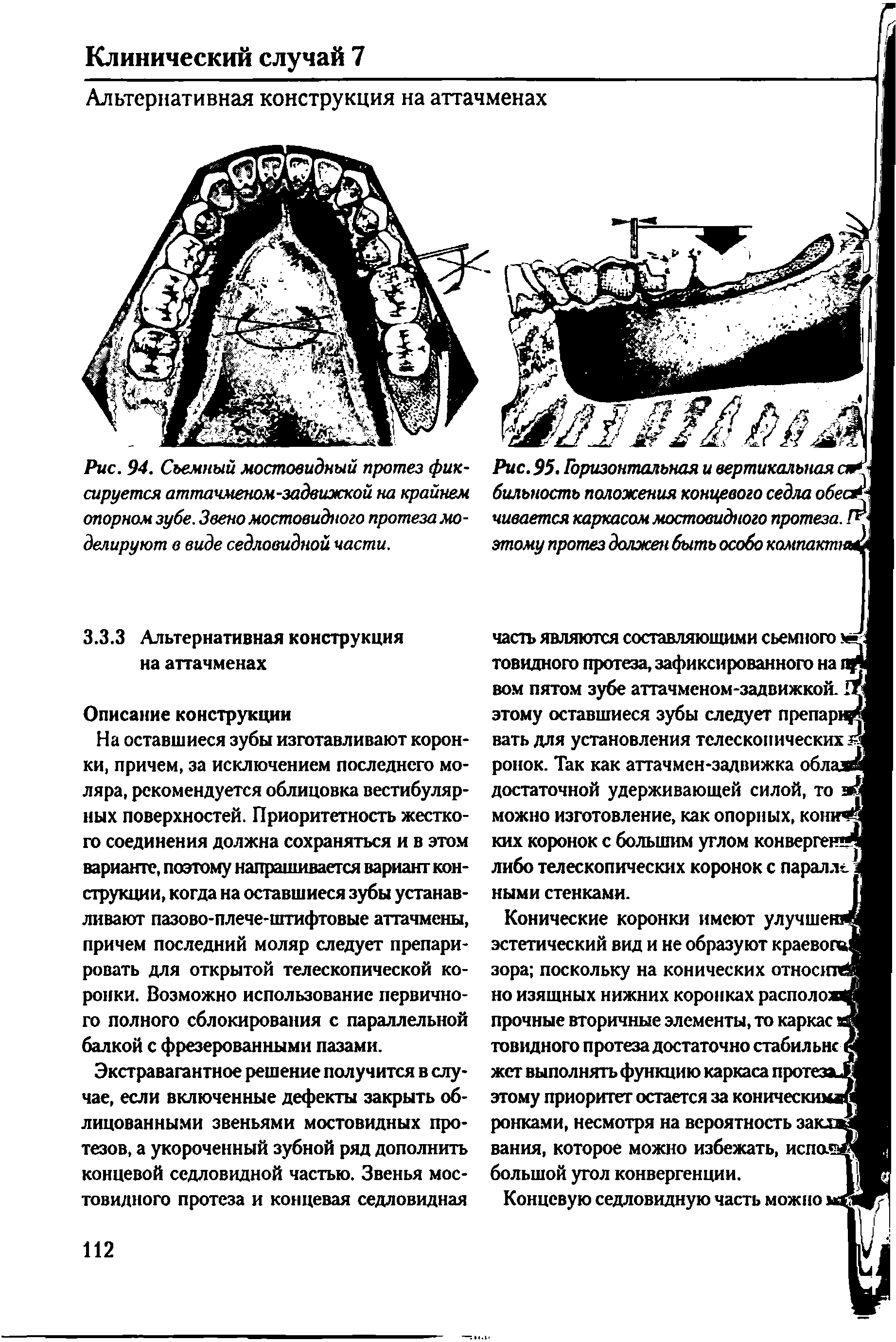 Рис. 95. Горизонтальная и вертикальная сям дальность положения концевого седла обеам чивается каркасом мостовидного протеза. ЛЧ...