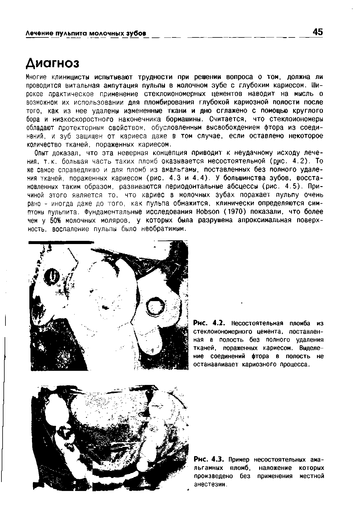 Рис. 4.2. Несостоятельная пломба из стеклоиономерного цемента, поставленная в полость без полного удаления тканей, пораженных кариесом. Выделение соединений фтора в полость не останавливает кариозного процесса.