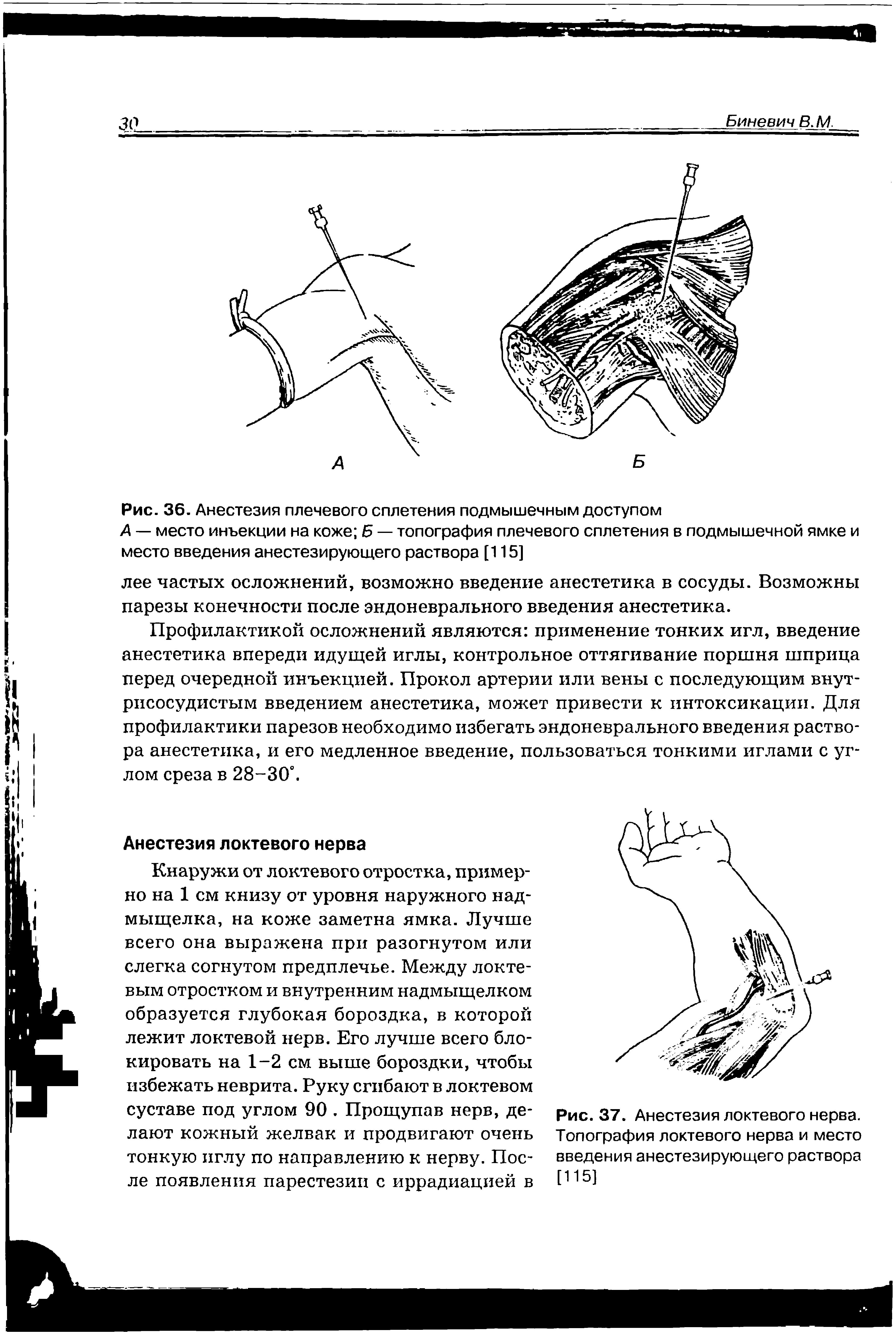 Рис. 37. Анестезия локтевого нерва. Топография локтевого нерва и место введения анестезирующего раствора [115]...