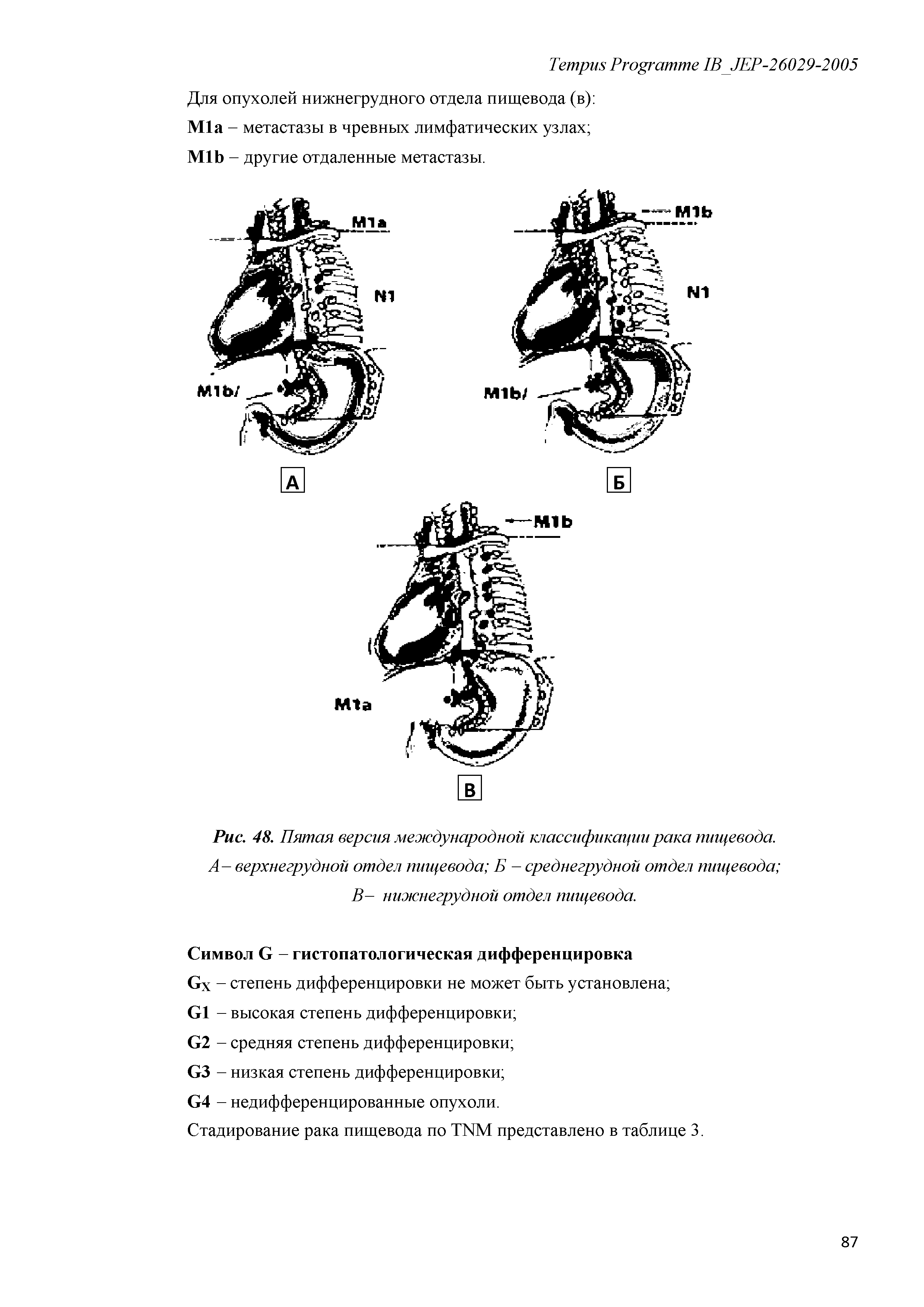 Рис. 48. Пятая версия международной классификации рака пищевода. А- верхнегрудной отдел пищевода Б - среднегрудной отдел пищевода ...