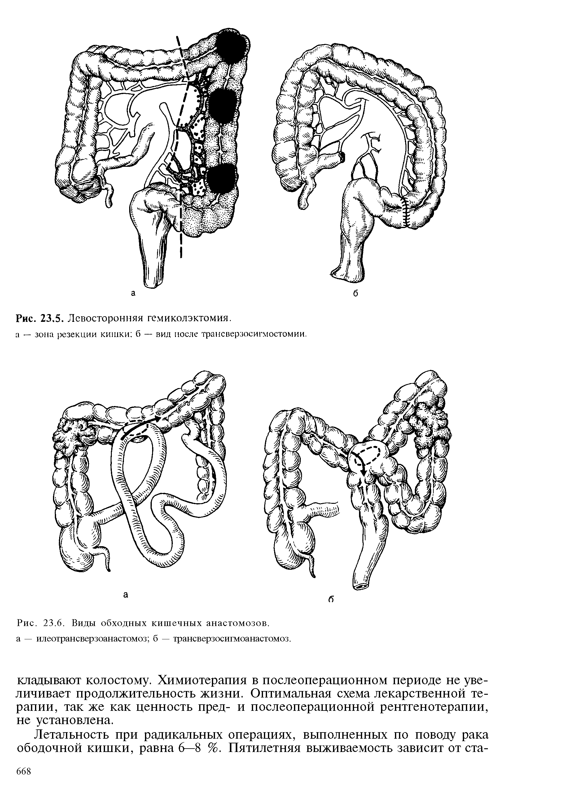 Рис. 23.6. Виды обходных кишечных анастомозов, а — илеотрансверзоанастомоз б — трансверзосигмоанастомоз.