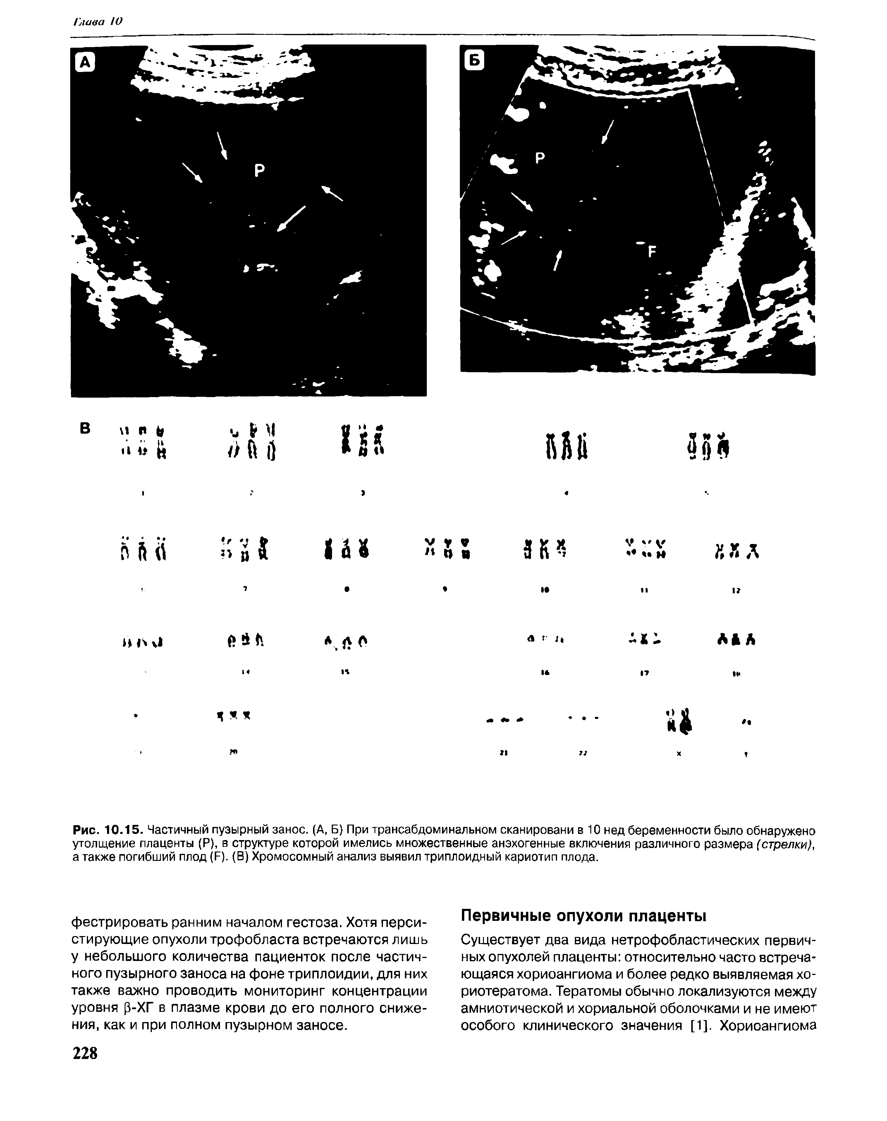 Рис. 10.15. Частичный пузырный занос. (А, Б) При трансабдоминальном сканировани в 10 нед беременности было обнаружено утолщение плаценты (Р), в структуре которой имелись множественные анэхогенные включения различного размера (стрелки), а также погибший плод (Б). (В) Хромосомный анализ выявил триплоидный кариотип плода.