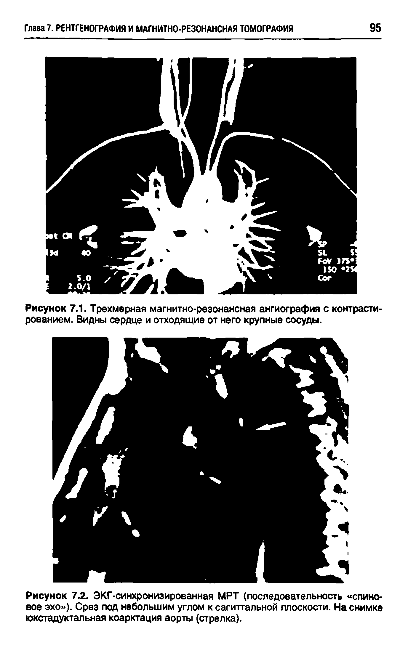 Рисунок 7.2. ЭКГ-синхронизированная МРТ (последовательность спиновое эхо ). Срез под небольшим углом к сагиттальной плоскости. На снимке юкстадуктальная коарктация аорты (стрелка).