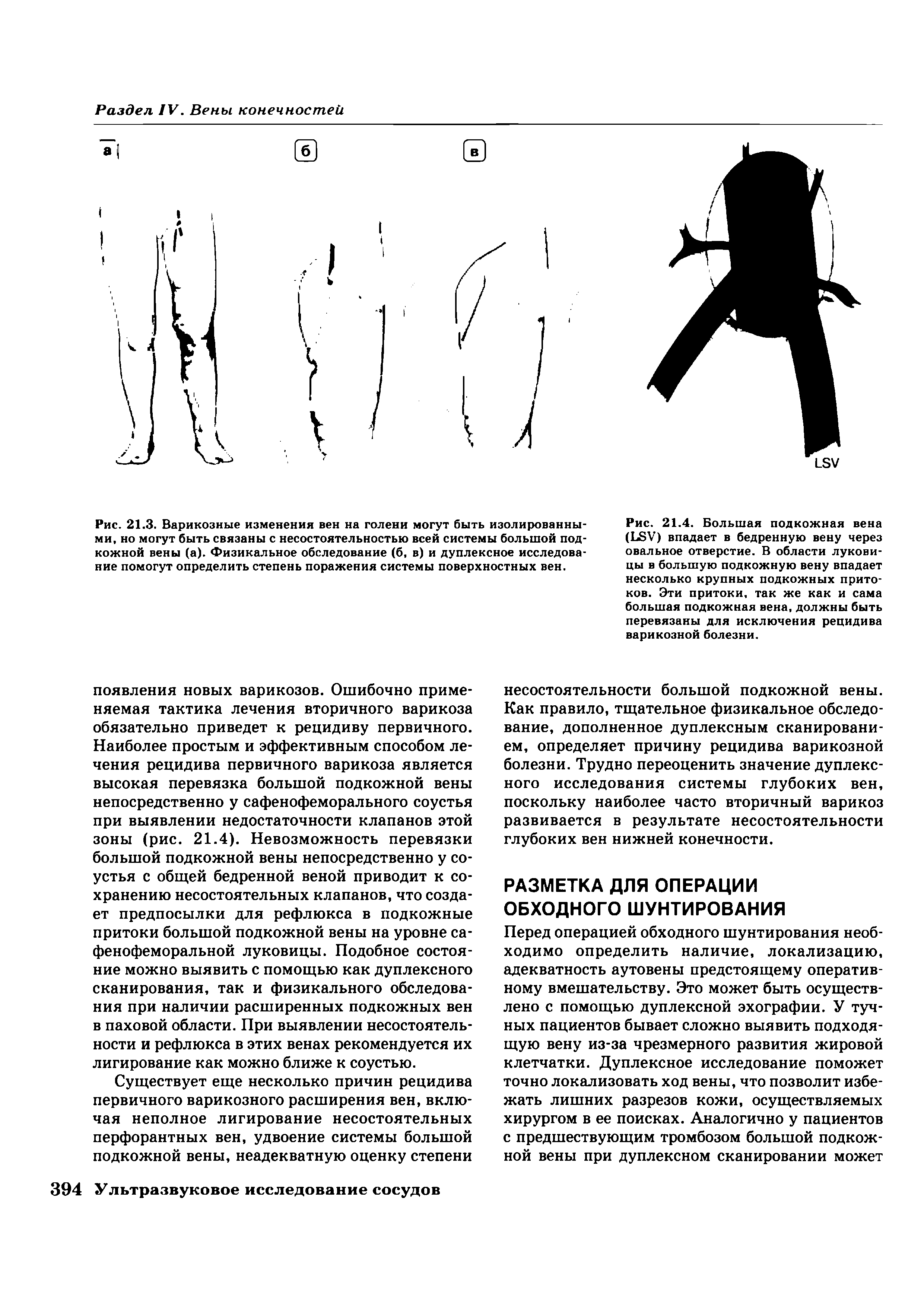 Рис. 21.3. Варикозные изменения вен на голени могут быть изолированными, но могут быть связаны с несостоятельностью всей системы большой подкожной вены (а). Физикальное обследование (б, в) и дуплексное исследование помогут определить степень поражения системы поверхностных вен.