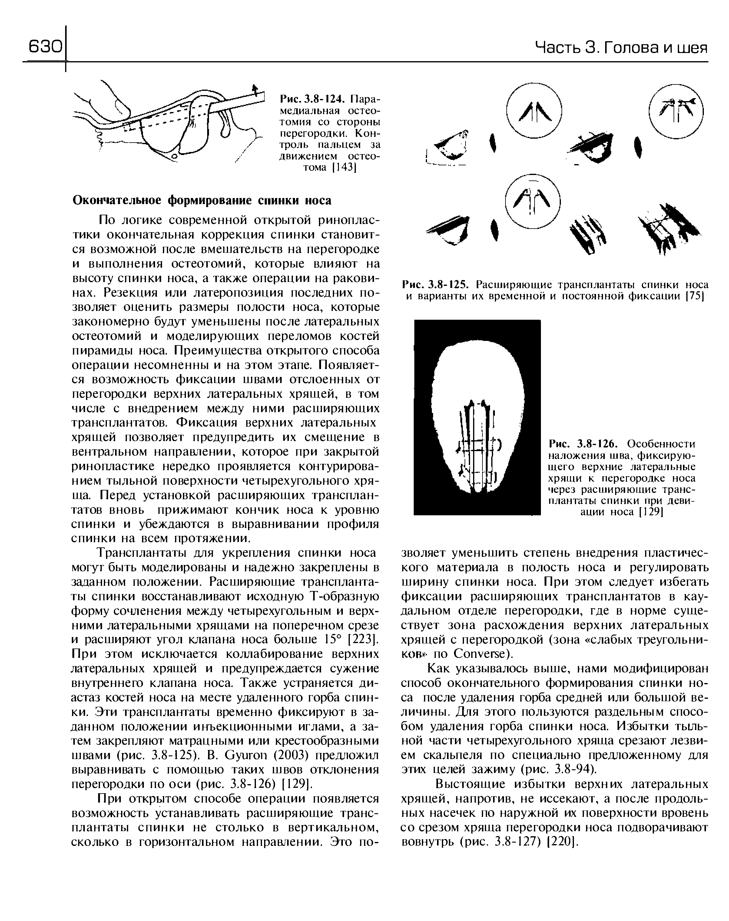 Рис. 3.8-125. Расширяющие трансплантаты спинки носа и варианты их временной и постоянной фиксации [75]...
