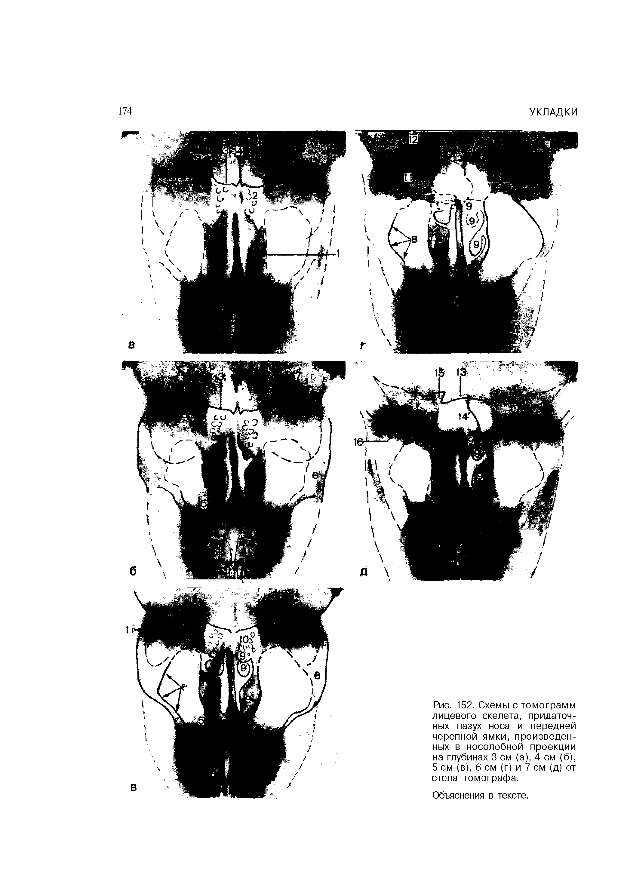 Рис. 152. Схемы с томограмм лицевого скелета, придаточных пазух носа и передней черепной ямки, произведенных в носолобной проекции на глубинах 3 см (а), 4 см (б), 5 см (в), 6 см (г) и 7 см (д) от стола томографа.