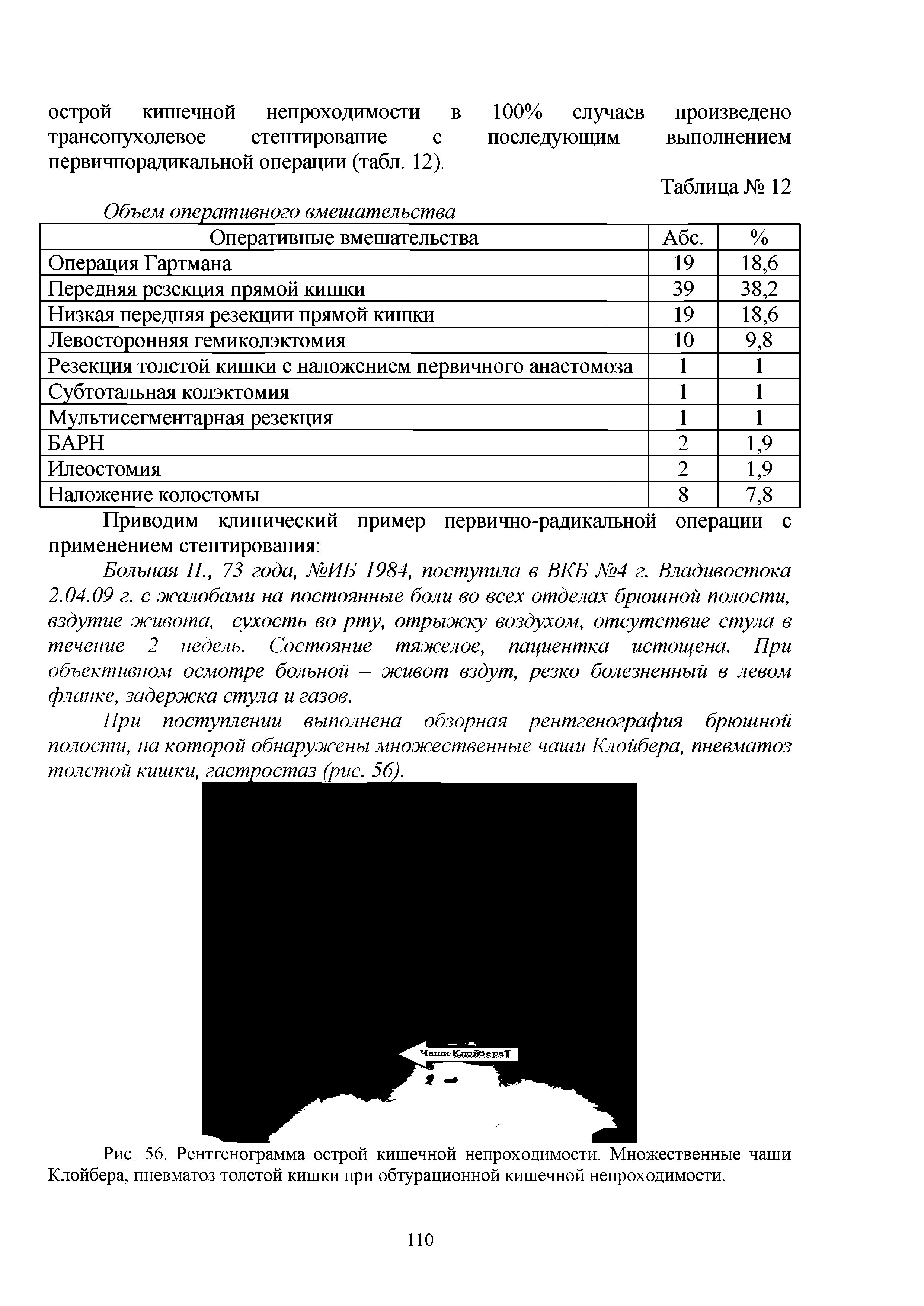 Рис. 56. Рентгенограмма острой кишечной непроходимости. Множественные чаши Клойбера, пневматоз толстой кишки при обтурационной кишечной непроходимости.