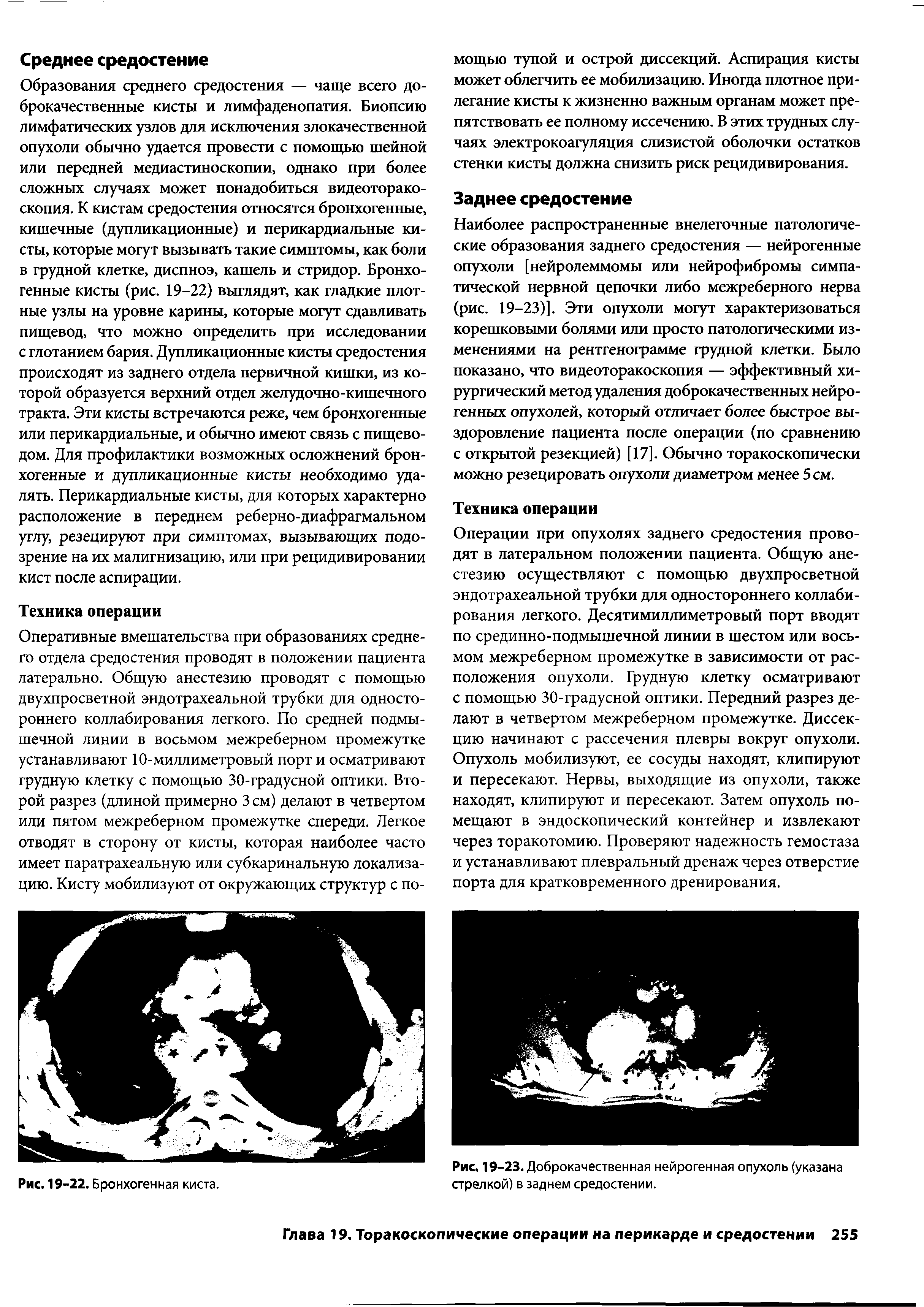 Рис. 19-23. Доброкачественная нейрогенная опухоль (указана стрелкой) в заднем средостении.