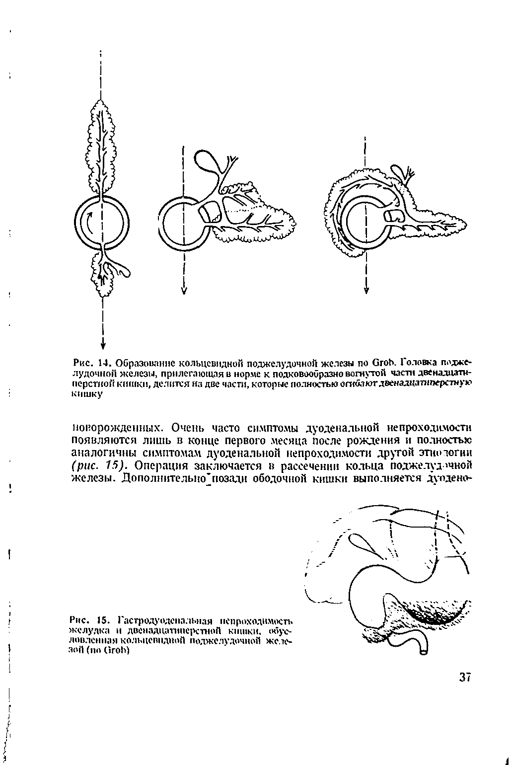 Рис. 15. Гастродуоденальная непроходимость желудка и двенадцатиперстной кишки, условленная кольцевидной поджелудочной железой (по G )...