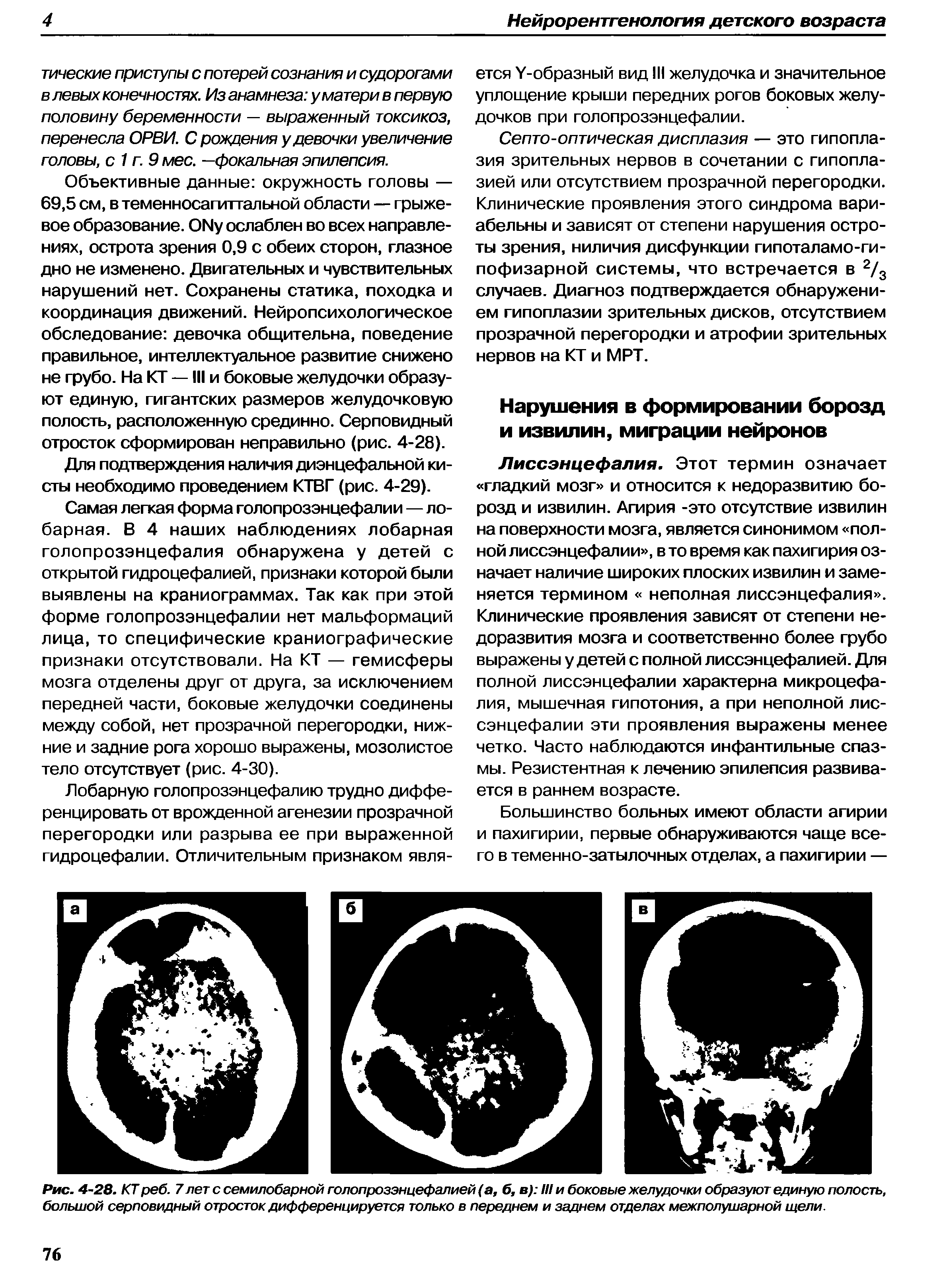 Рис. 4-28. КТ реб. 7 лет с семилобарной голопрозэнцефалией (а, б, в) III и боковые желудочки образуют единую полость, большой серповидный отросток дифференцируется только в переднем и заднем отделах межполушарной щели.