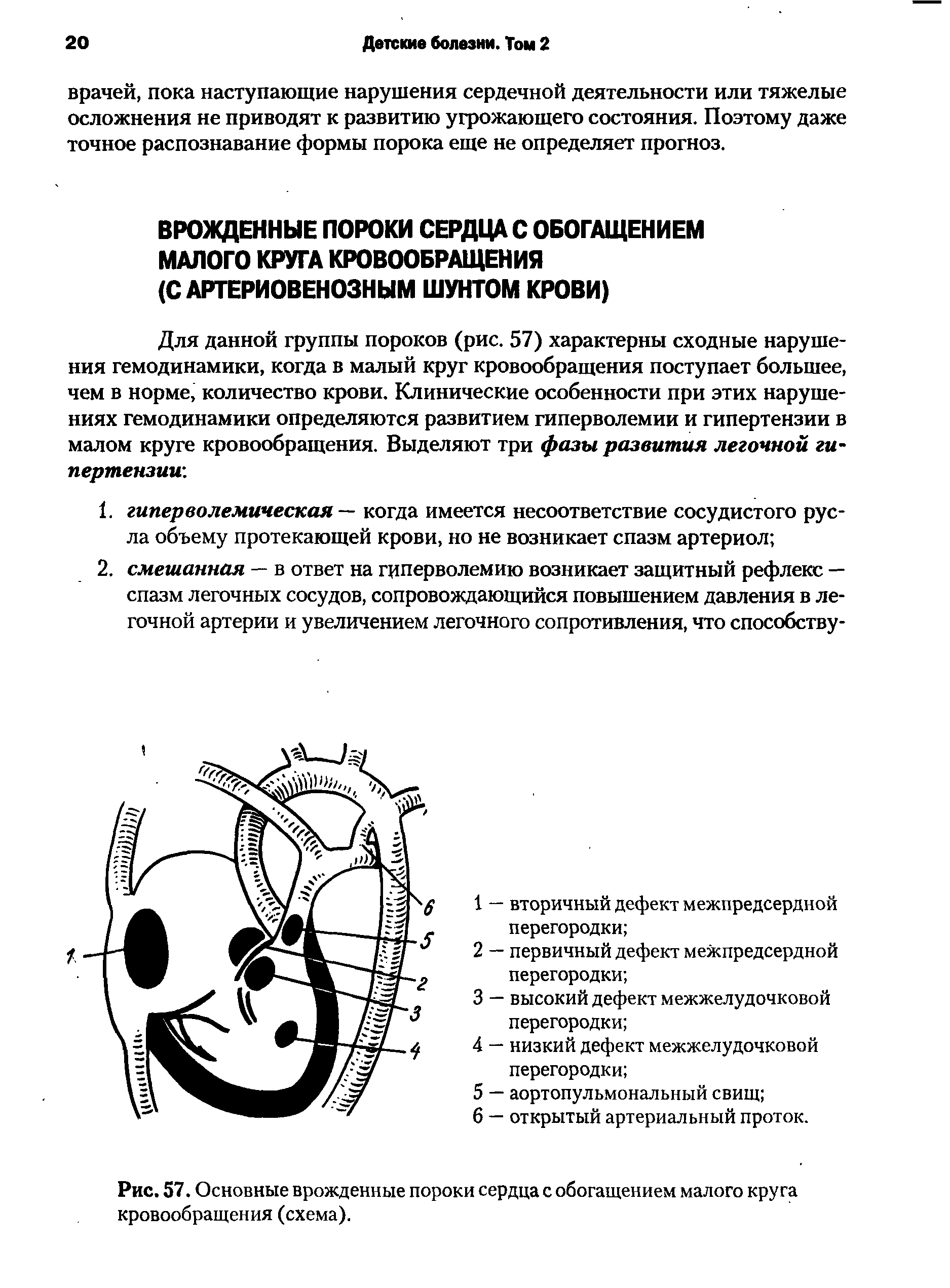 Рис. 57. Основные врожденные пороки сердца с обогащением малого круга кровообращения (схема).