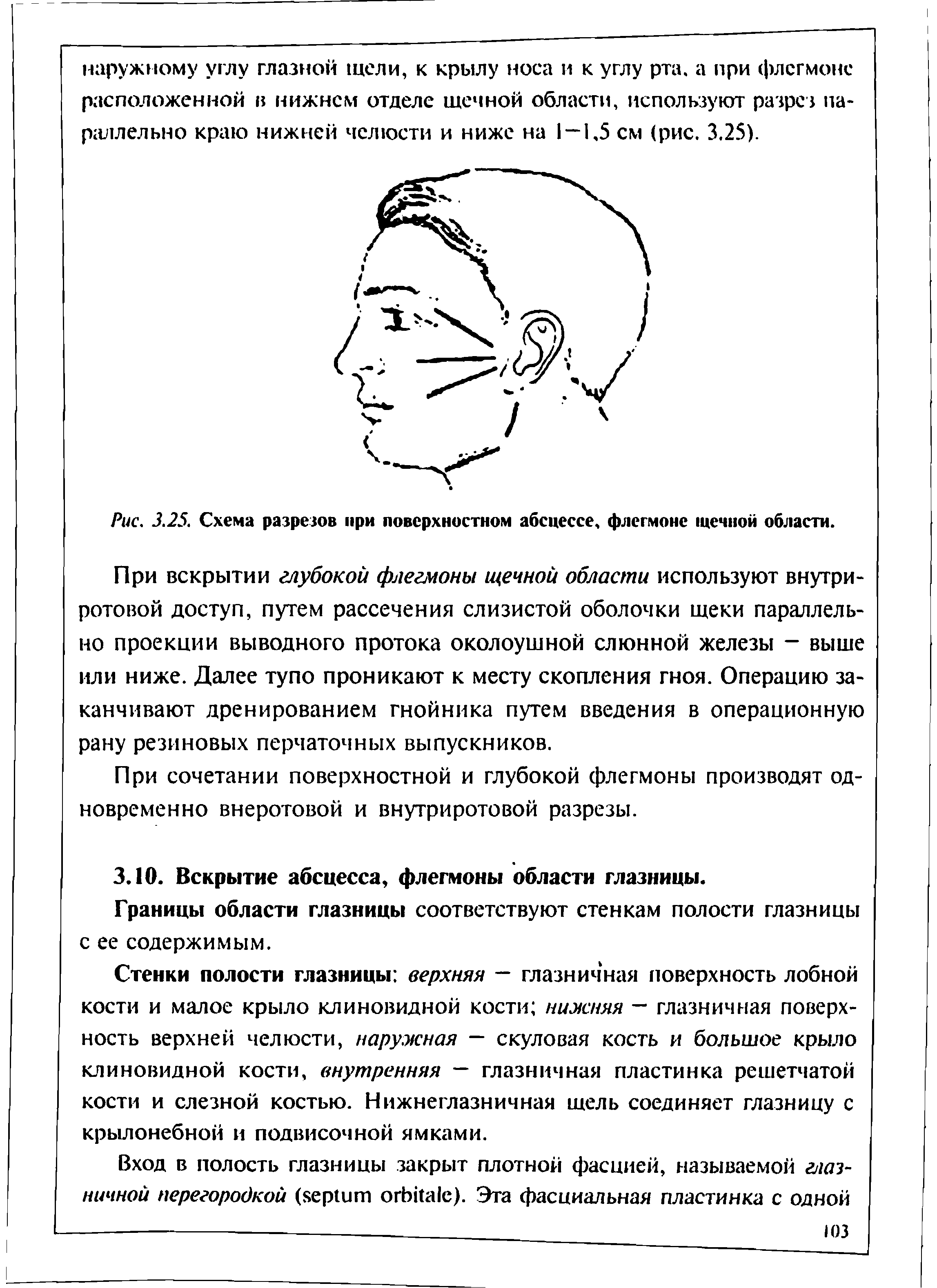 Рис. 3.25. Схема разрезов при поверхностном абсцессе, флегмоне щечной области.