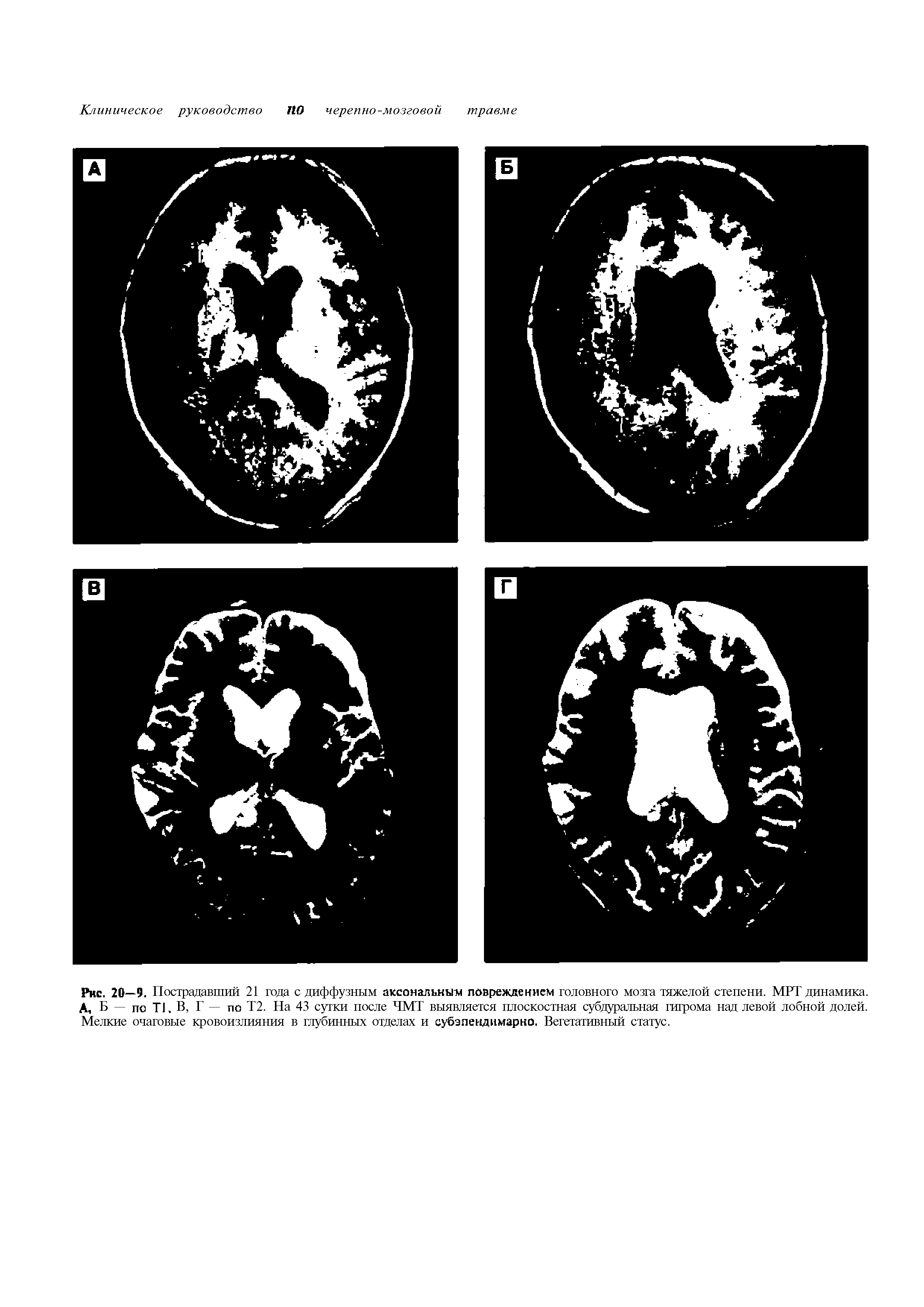Рис. 20—9. Пострадавший 21 года с диффузным аксональным повреждением головного мозга тяжелой степени. МРТ динамика. А, Б — по TJ, В, Г — по Т2. На 43 сутки после ЧМТ выявляется плоскостная субдуральная гигрома над левой лобной долей. Мелкие очаговые кровоизлияния в глубинных отделах и субэпендимарно. Вегетативный статус.