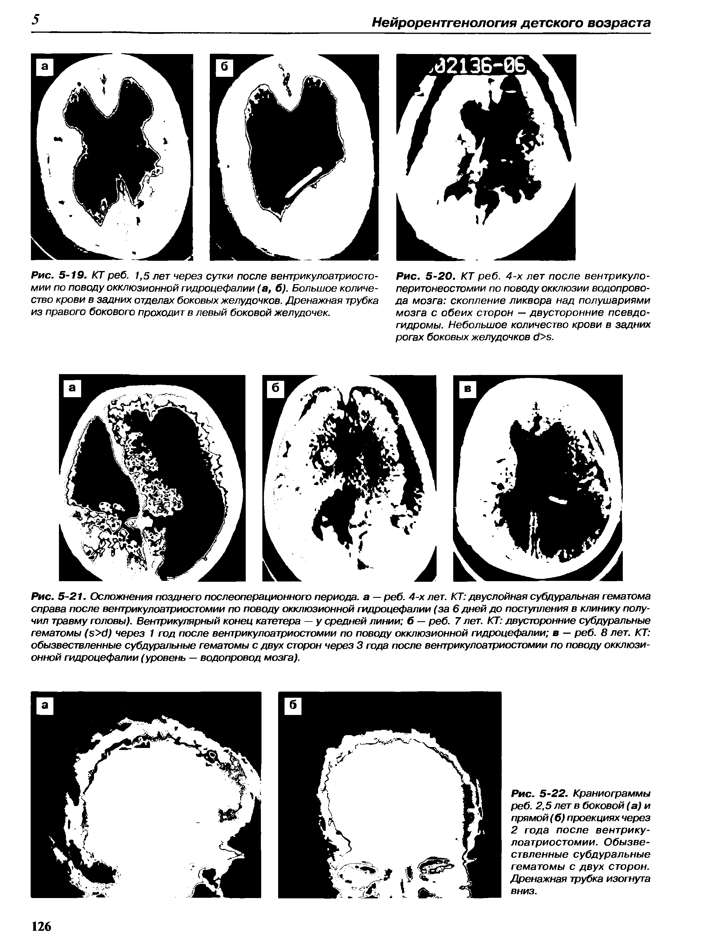 Рис. 5-22. Краниограммы реб. 2,5 лет в боковой (а) и прямой (б) проекциях через 2 года после вентрикулоатриостомии. Обызвествленные субдуральные гематомы с двух сторон. Дренажная трубка изогнута вниз.