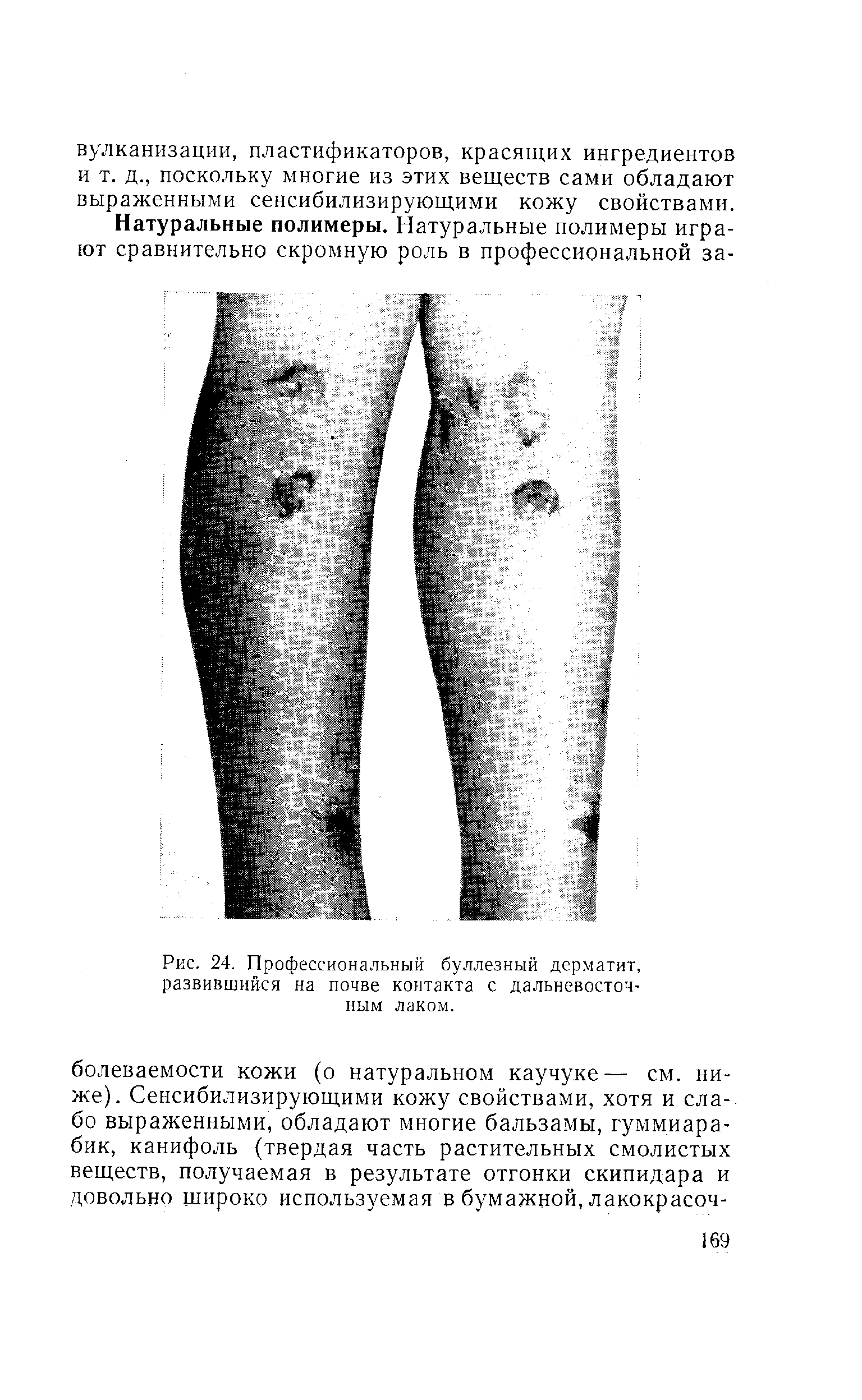 Рис. 24. Профессиональный буллезный дерматит, развившийся на почве контакта с дальневосточным лаком.