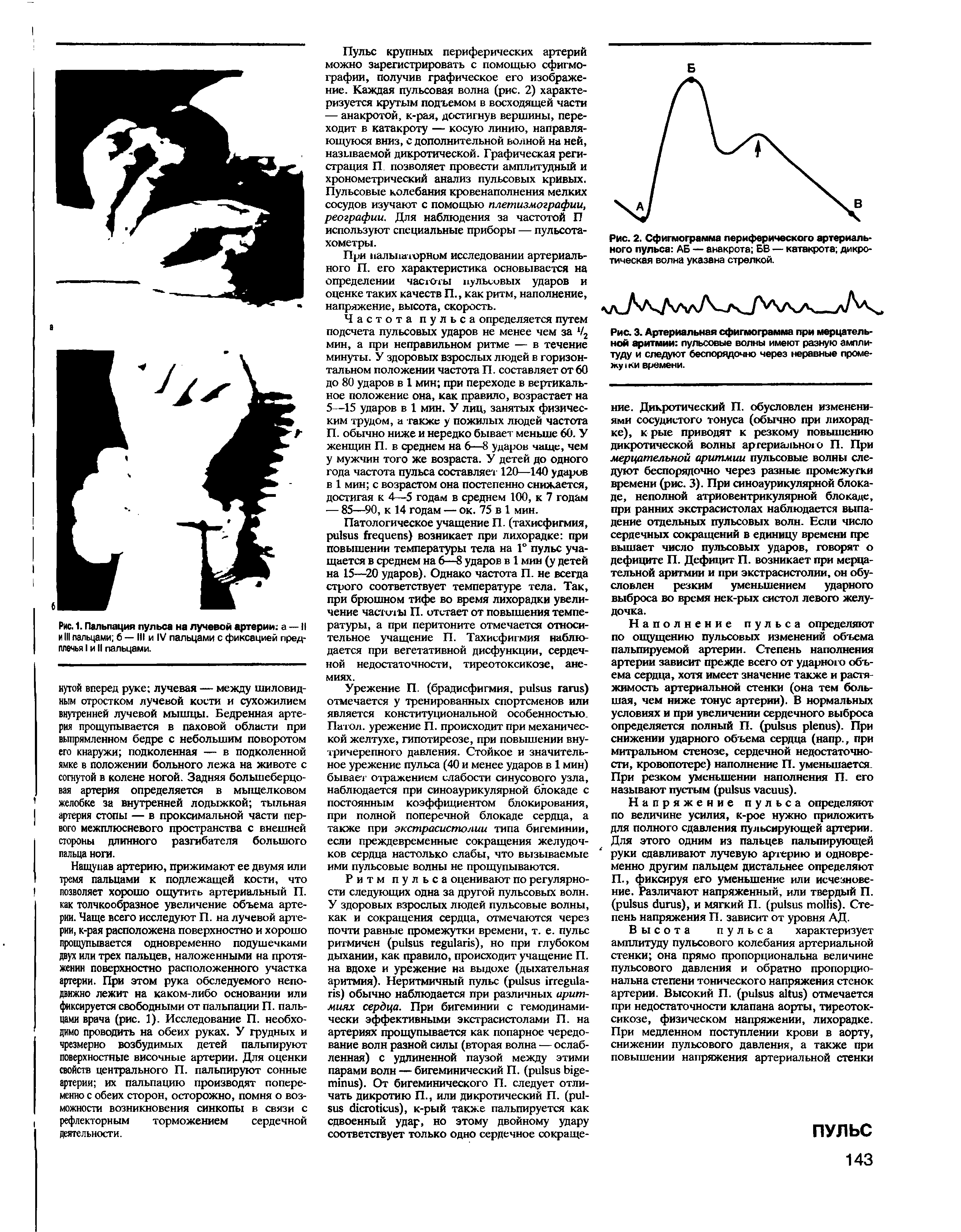 Рис. 2. Сфигмограмма периферического артериального пульса АБ — анакрота БВ — катакрота дикротическая волна указана стрелкой.