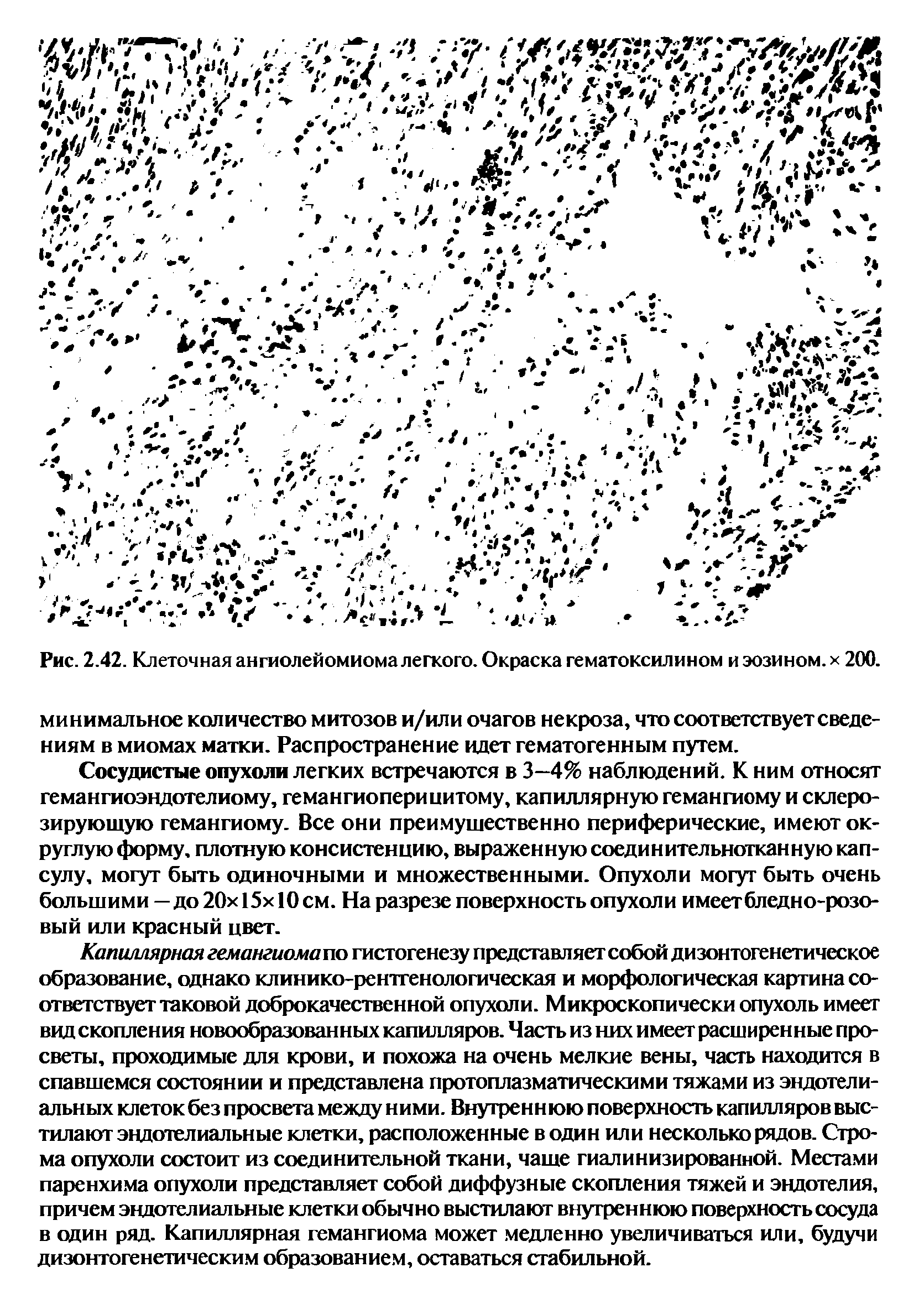 Рис. 2.42. Клеточная ангиолейомиома легкого. Окраска гематоксилином и эозином, х 200.