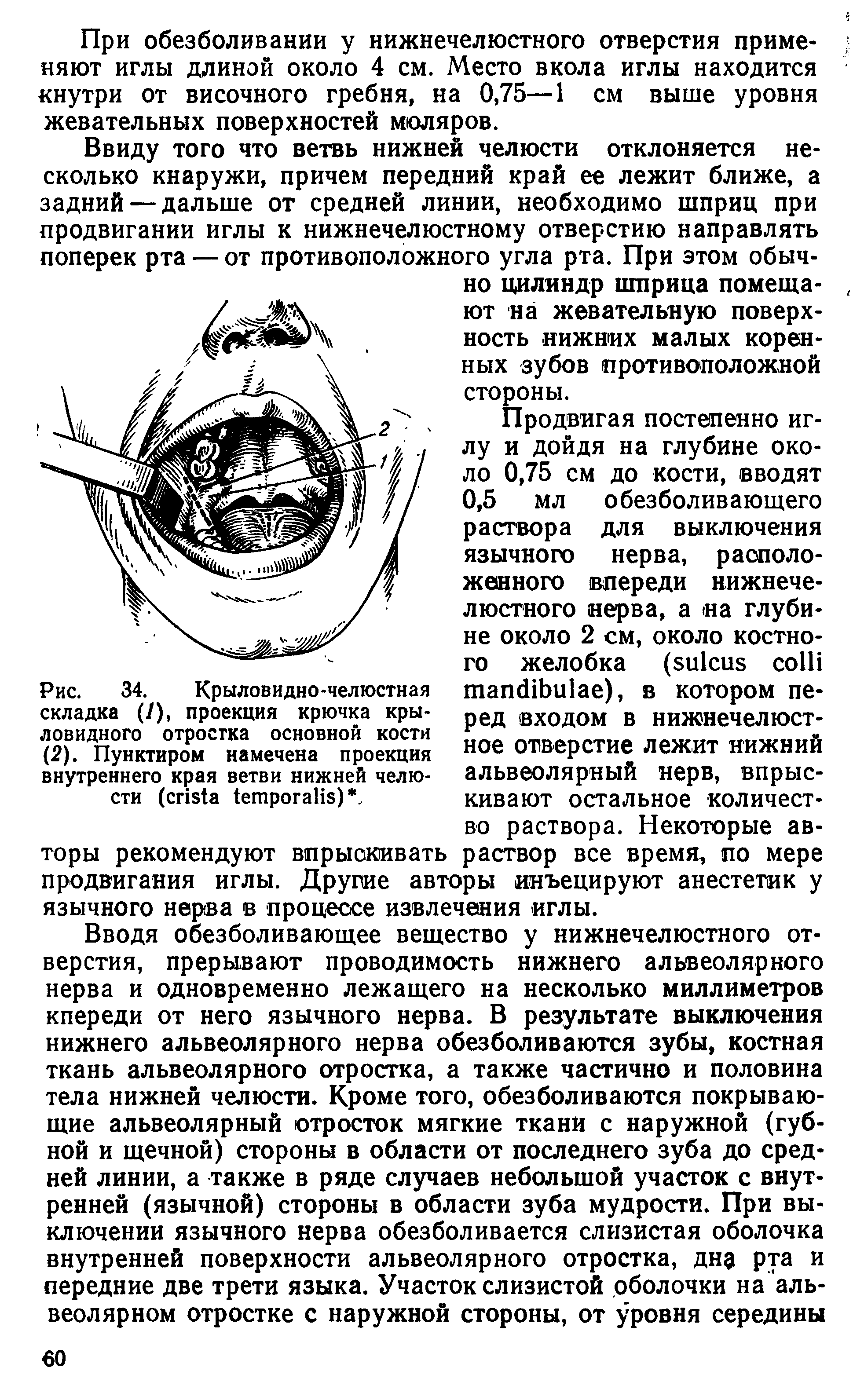 Рис. 34. Крыловидно-челюстная складка (/), проекция крючка крыловидного отростка основной кости (2). Пунктиром намечена проекция внутреннего края ветви нижней челюсти ( ), ...