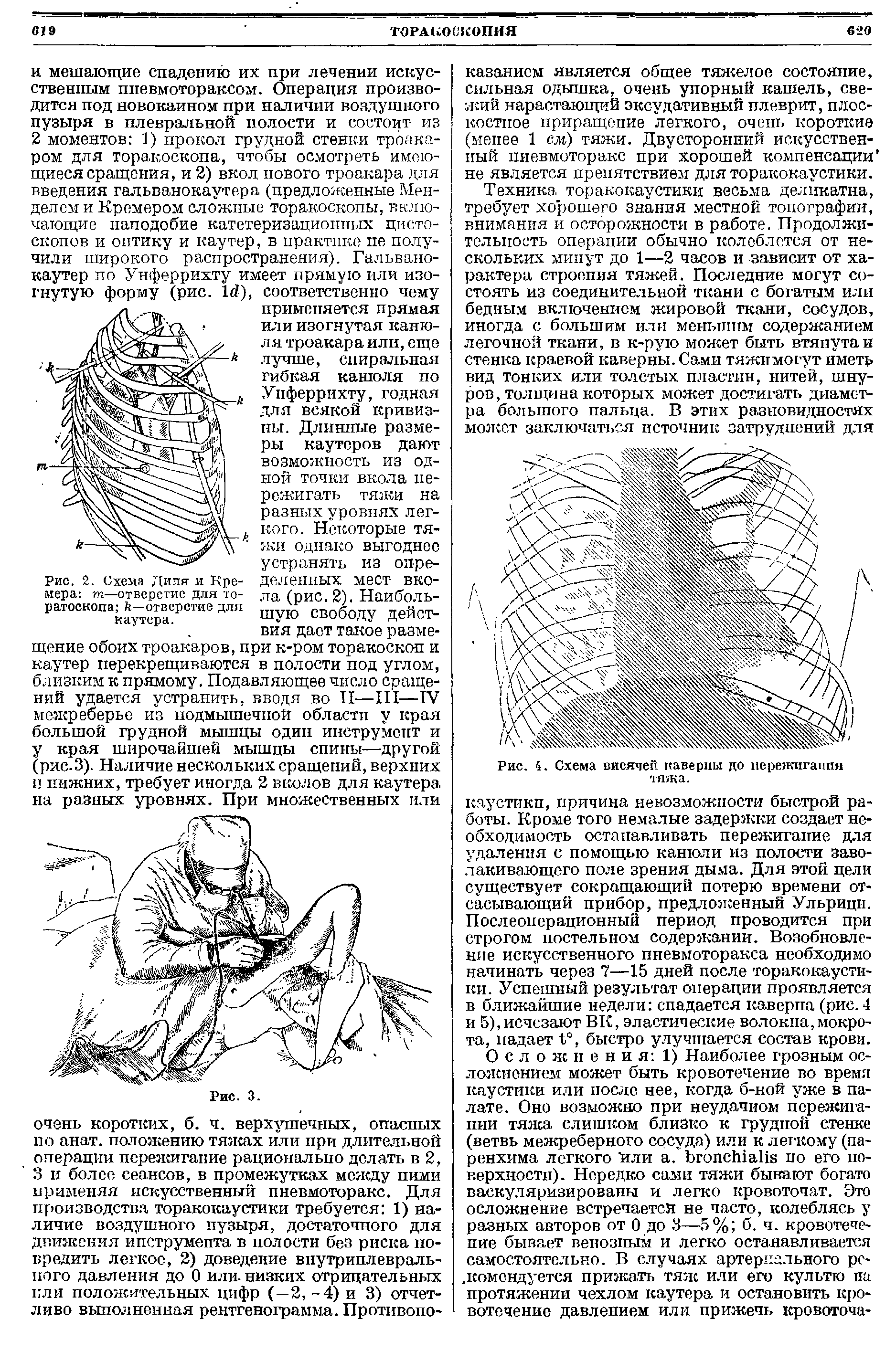 Рис. 2. Схема Диля и Кремера т—отверстие для то-ратоскопа к—отверстие для каутера.