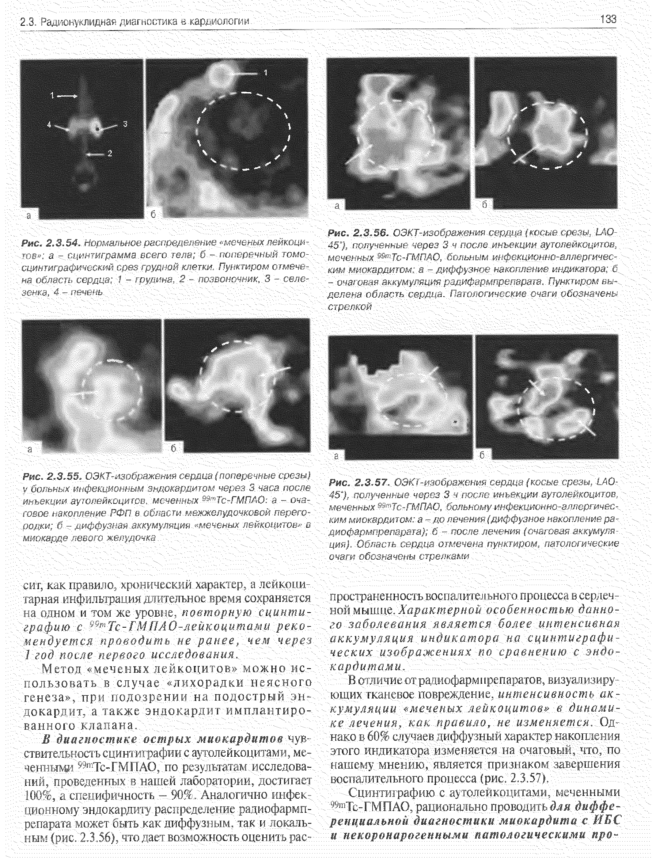 Рис. 2,3.55. ОЭКТ-изображения сердца(поперечные срезы) у больных инфекционным эндокардитом через 3 часа после инъекции аутолейкоцитов, меченных 9а пТс-ГМПАО а - очаговое накопление РФП в области межжелудочковой перегородки б - диффузная.аккумуляция, меченых лейкоцитов - в миокарде левого желудочка т...