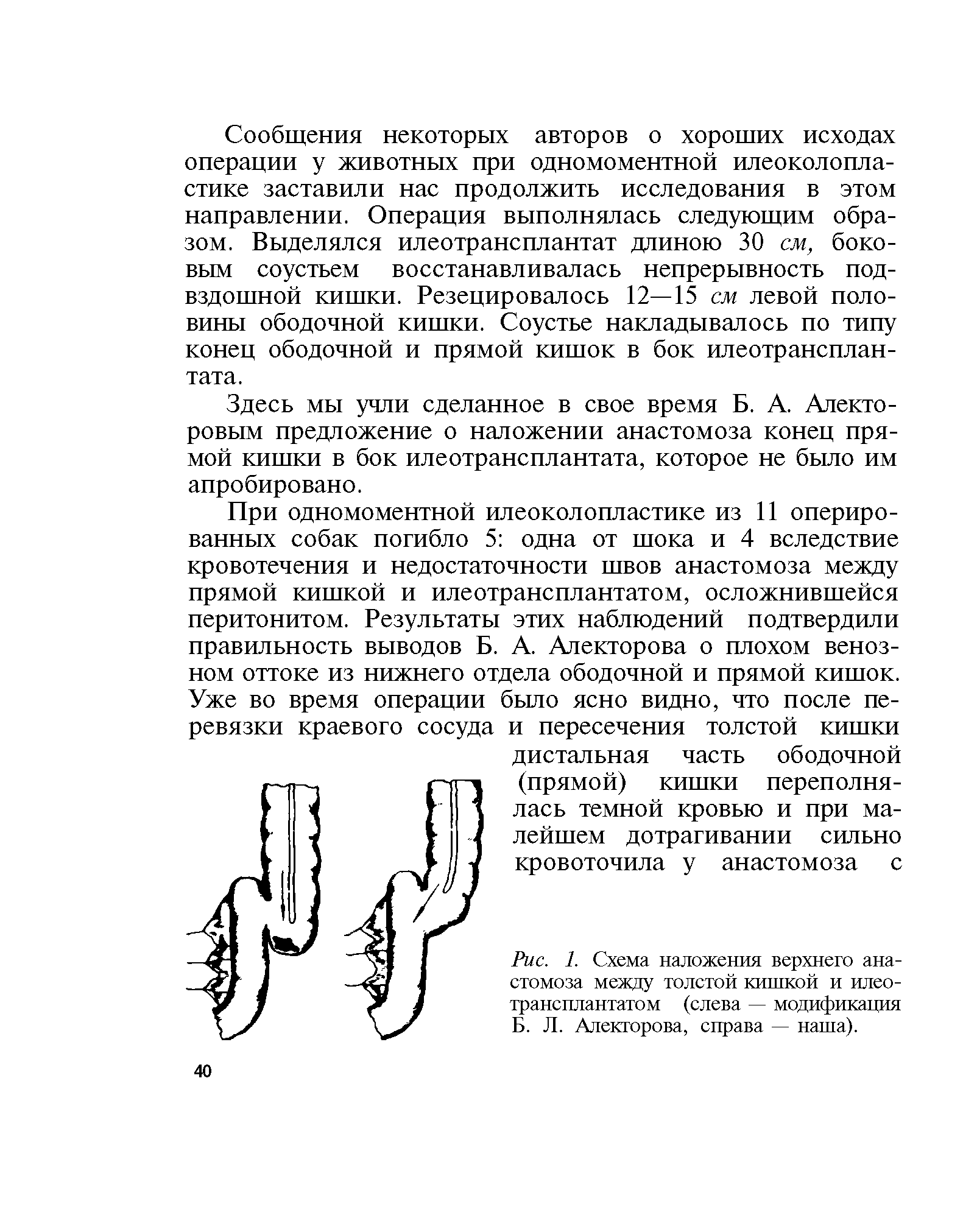 Рис. 1. Схема наложения верхнего анастомоза между толстой кишкой и илеотрансплантатом (слева — модификация Б. Л. Алекторова, справа — наша).