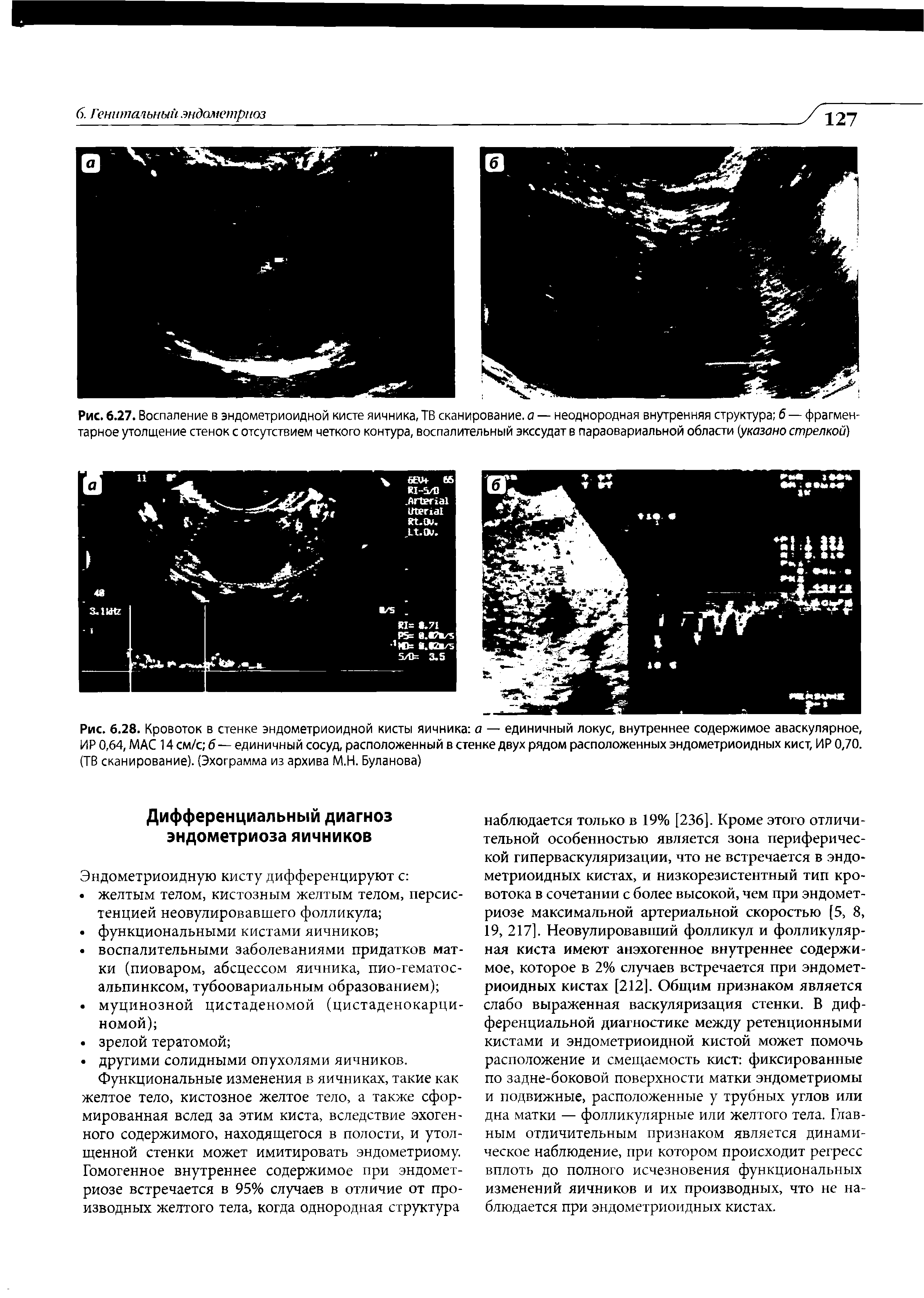 Рис. 6.28. Кровоток в стенке эндометриоидной кисты яичника а — единичный локус, внутреннее содержимое аваскулярное, ИР 0,64, МАС 14 см/с б — единичный сосуд, расположенный в стенке двух рядом расположенных эндометриоидных кист, ИР 0,70. (ТВ сканирование). (Эхограмма из архива М.Н. Буланова)...