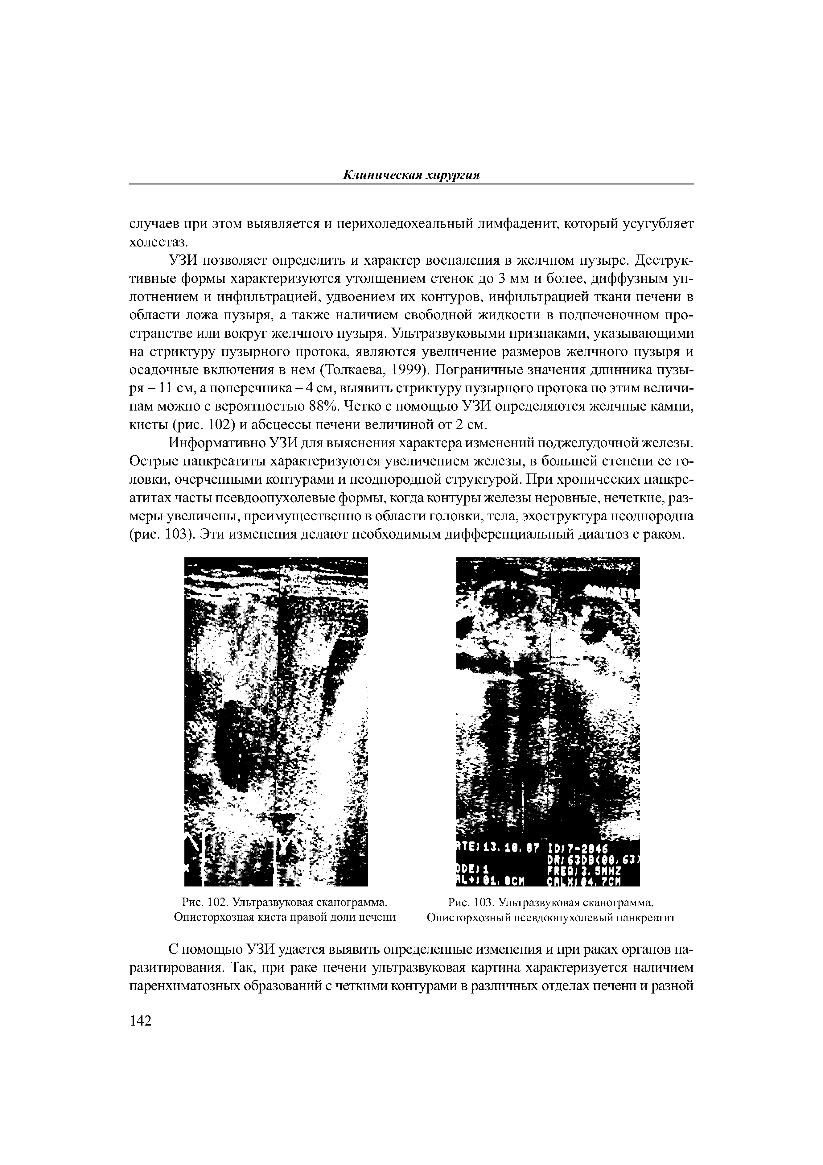 Рис. 102. Ультразвуковая сканограмма. Описторхозная киста правой доли печени...