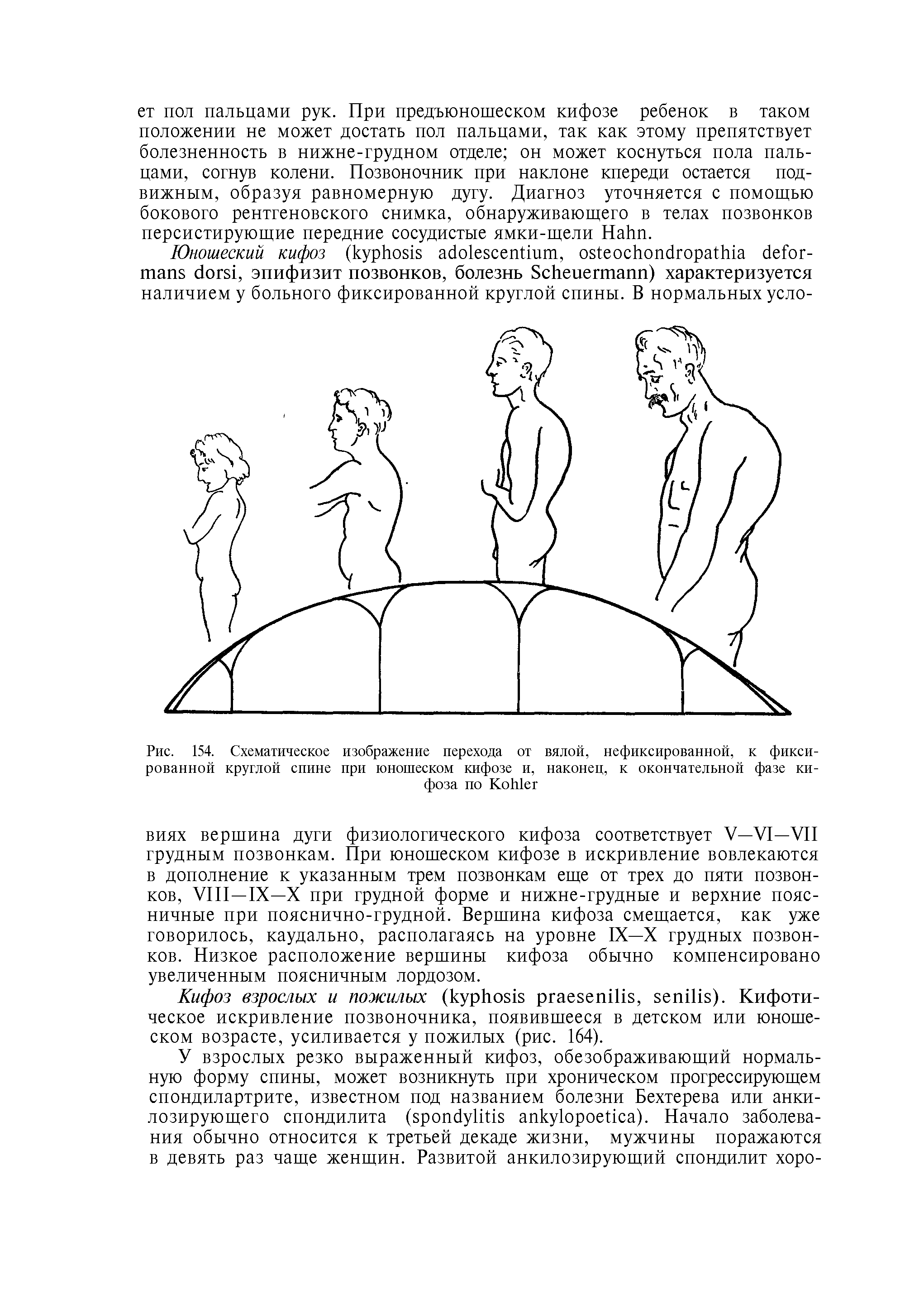 Рис. 154. Схематическое изображение перехода от вялой, нефиксированной, к фиксированной круглой спине при юношеском кифозе и, наконец, к окончательной фазе кифоза по K ...