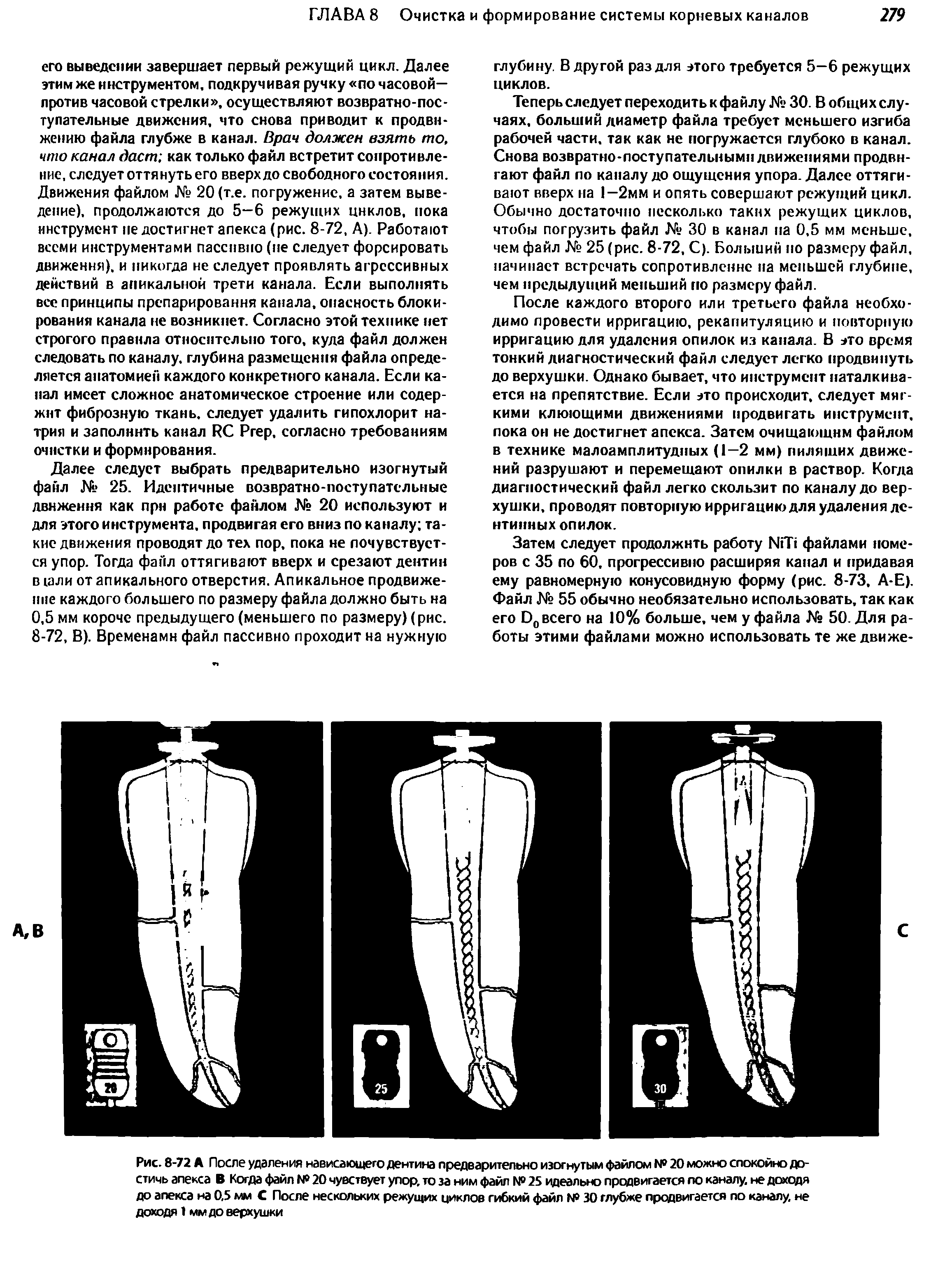 Рис. 8-72 А После удаления нависающего дентина предварительно изогнутым файлом № 20 можно спокойно достичь апекса В Когда файл № 20 чувствует упор, то за ним файл N 25 идеально продвигается по каналу, не доходя до апекса на 0,5 мм С После нескольких режущих циклов гибкий файл N0 30 глубже продвигается по каналу, не доходя 1 мм до верхушки...