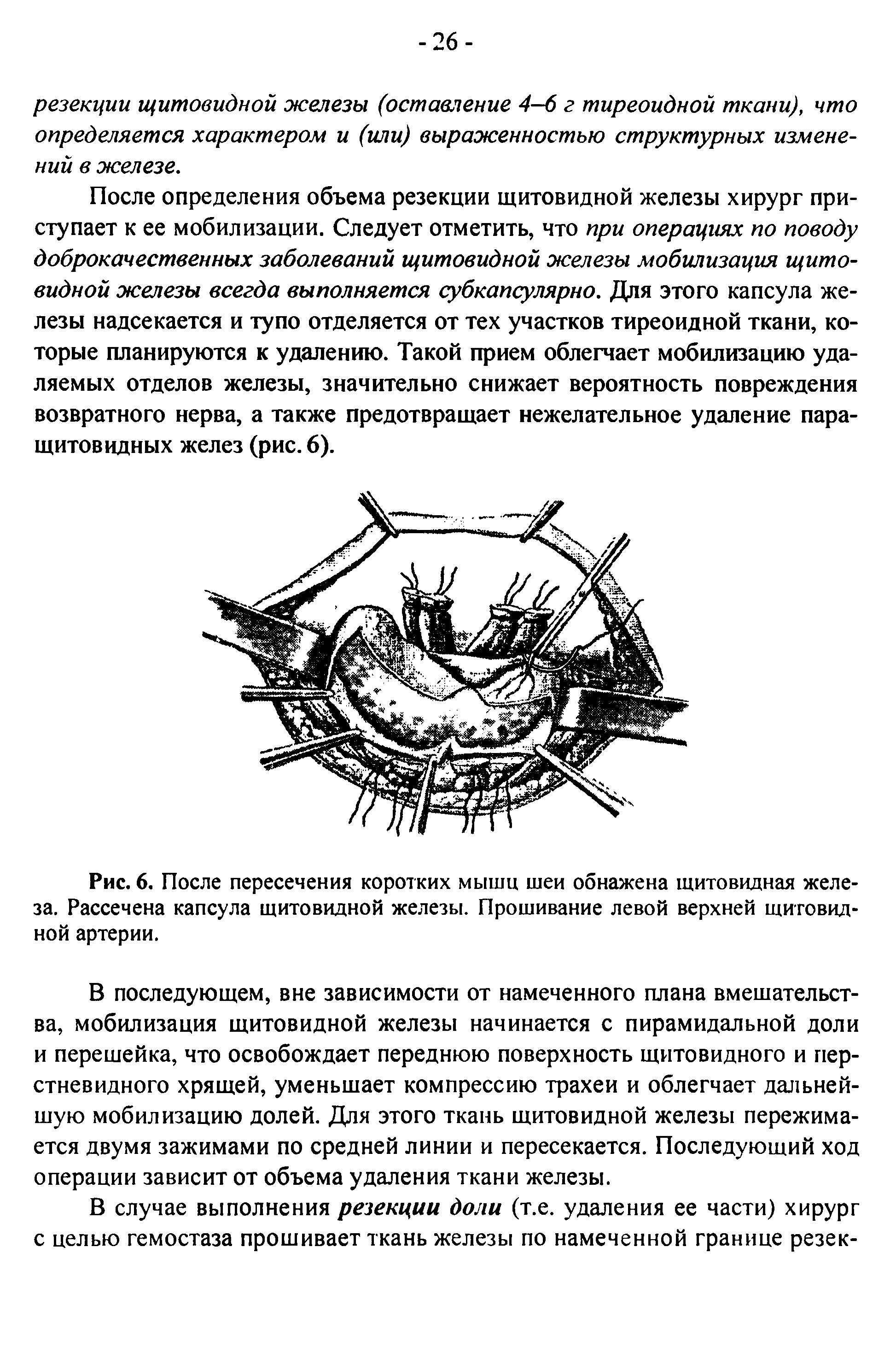 Рис. 6. После пересечения коротких мышц шеи обнажена щитовидная железа. Рассечена капсула щитовидной железы. Прошивание левой верхней щитовидной артерии.