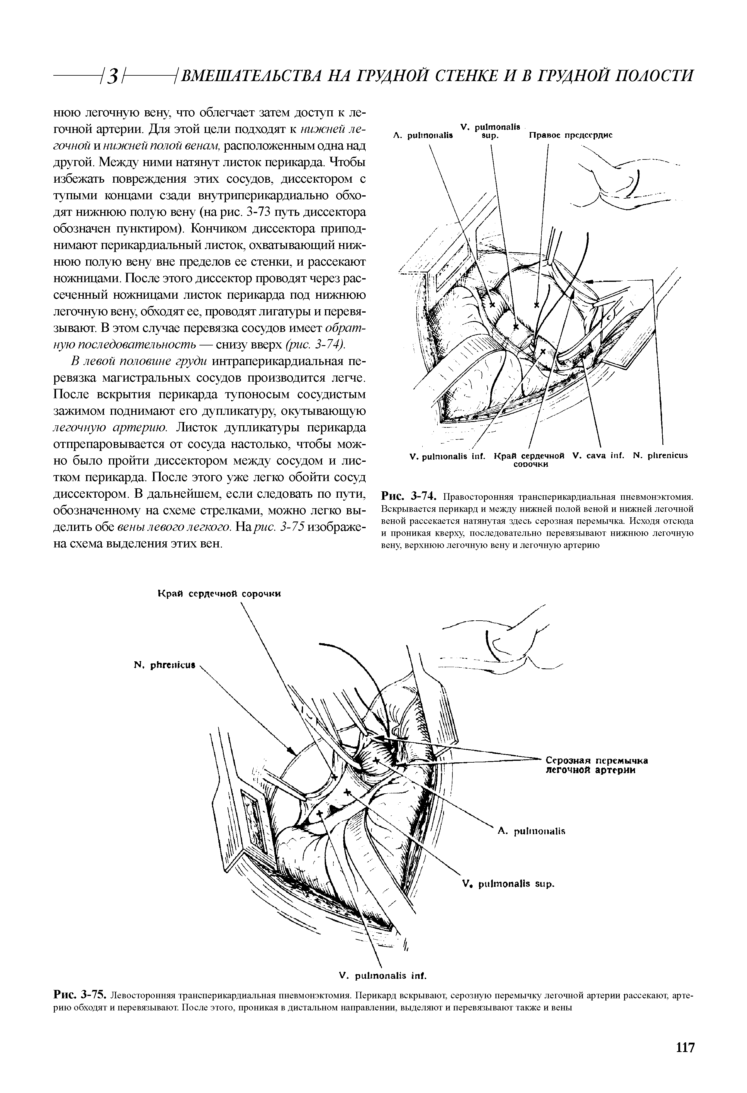 Рис. 3-74. Правосторонняя трансперикардиальная пневмонэктомия. Вскрывается перикард и между нижней полой веной и нижней легочной веной рассекается натянутая здесь серозная перемычка. Исходя отсюда и проникая кверху, последовательно перевязывают нижнюю легочную вену, верхнюю легочную вену и легочную артерию...