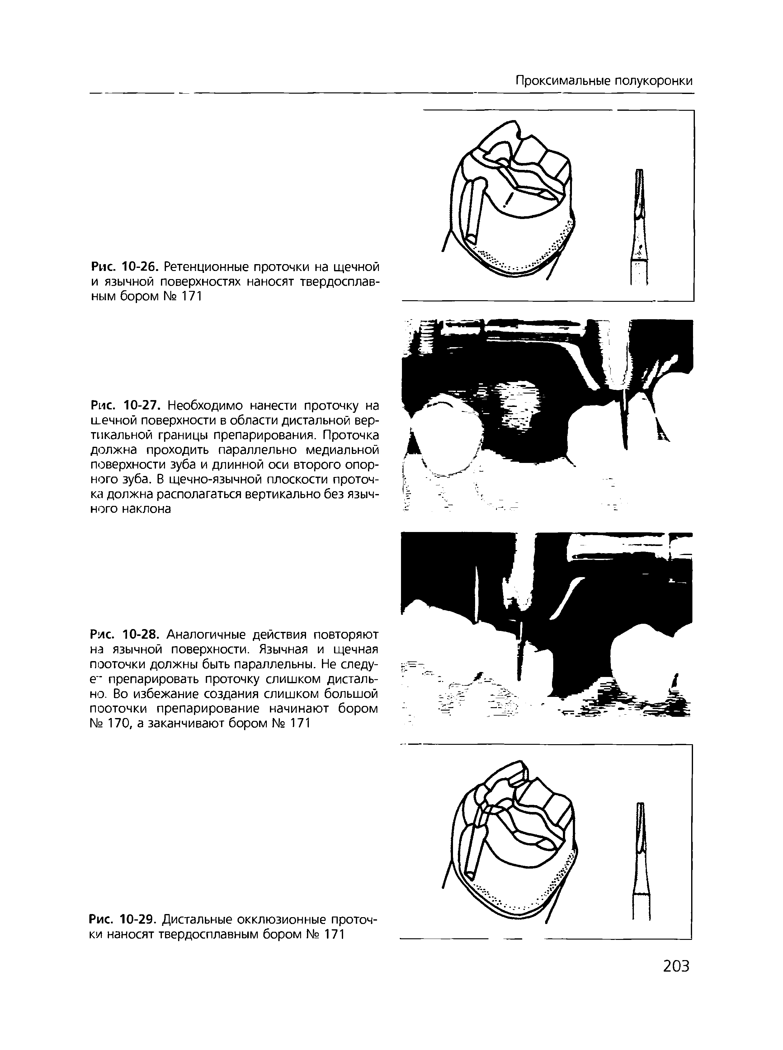 Рис. 10-27. Необходимо нанести проточку на шечной поверхности в области дистальной вертикальной границы препарирования. Проточка должна проходить параллельно медиальной поверхности зуба и длинной оси второго опорного зуба. В щечно-язычной плоскости проточ-кга должна располагаться вертикально без язычного наклона...