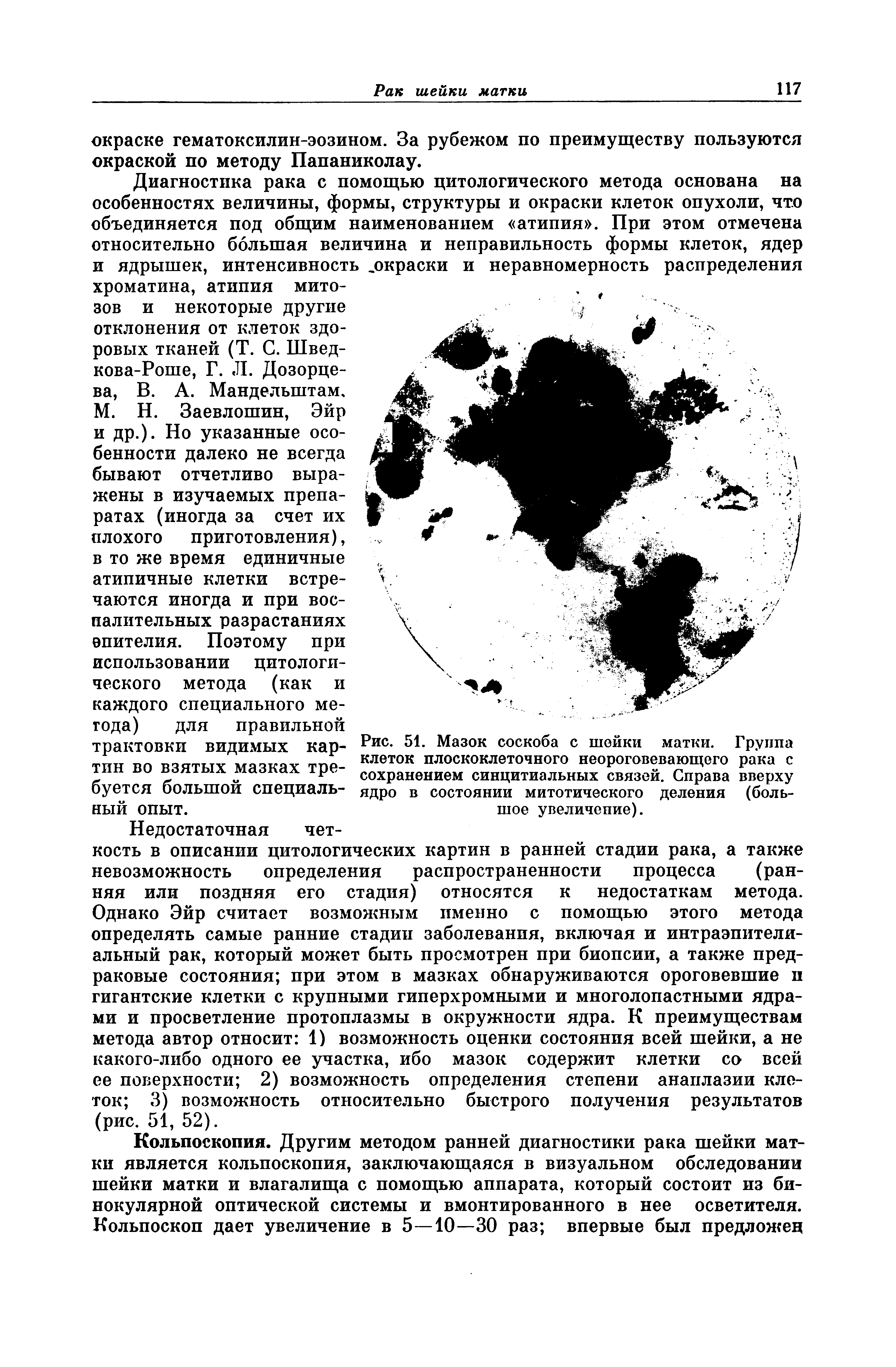 Рис. 51. Мазок соскоба с шейки матки. Группа клеток плоскоклеточного неороговевающего рака с сохранением синцитиальных связей. Справа вверху ядро в состоянии митотического деления (большое увеличение).