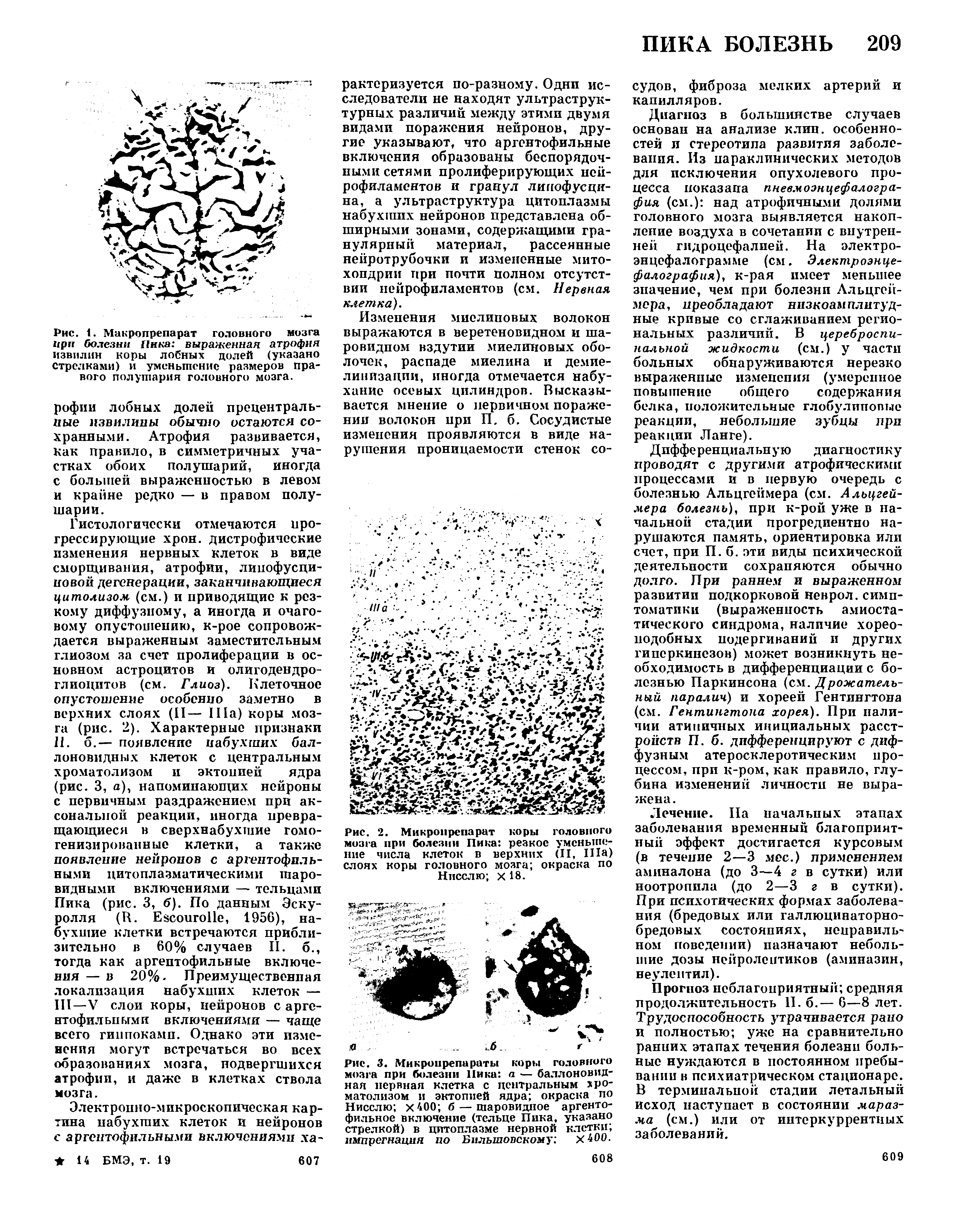 Рис. 1. Макропрепарат головного мозга при болезни Пика выраженная атрофия извилин коры лобных долей (указано стрелками) и уменьшение размеров правого полушария головного мозга.