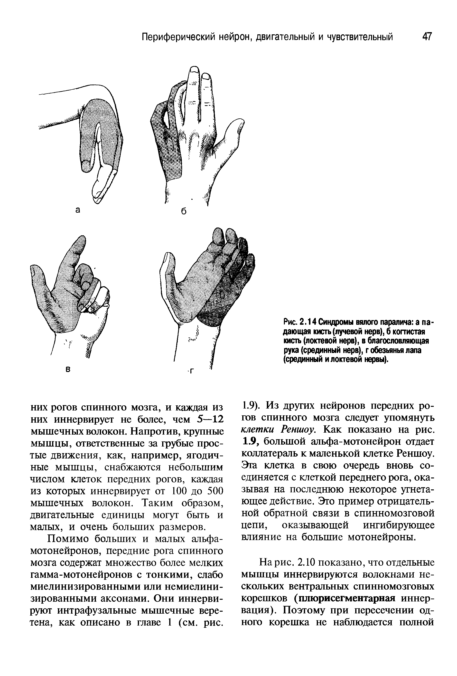 Рис. 2.14 Синдромы вялого паралича а па дающая кисть (лучевой нерв), б когтистая кисть (локтевой нерв), в благословляющая рука (срединный нерв), г обезьянья лапа (срединный и локтевой нервы).
