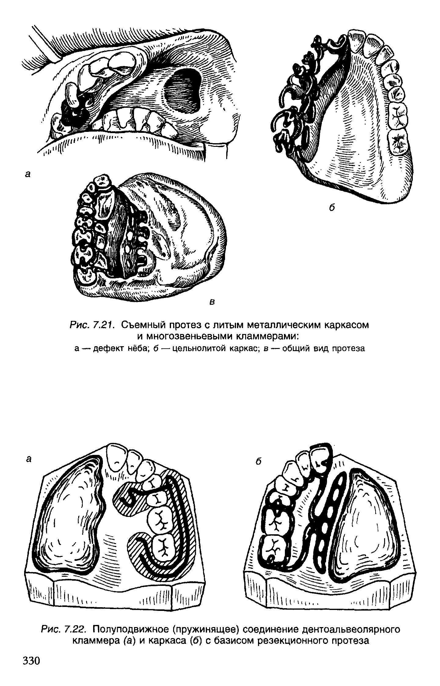 Рис. 7.22. Полуподвижное (пружинящее) соединение дентоапьвеолярного кламмера (а) и каркаса (б) с базисом резекционного протеза...