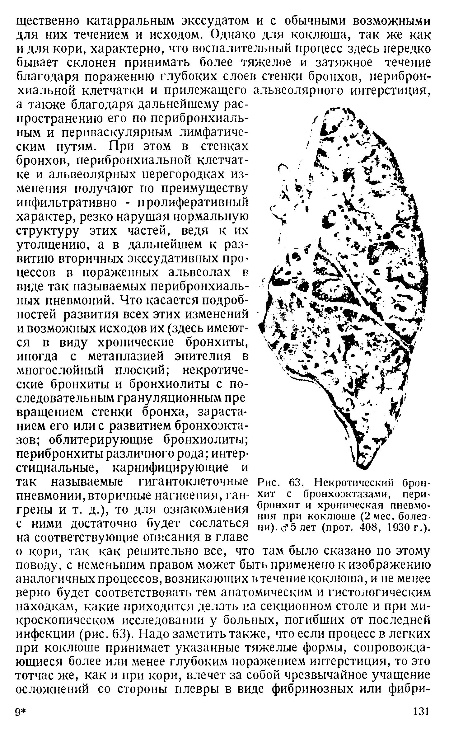 Рис. 63. Некротический бронхит с бронхоэктазами, перибронхит и хроническая пневмония при коклюше (2 мес. болезни). с 5 лет (прот. 408, 1930 г.).