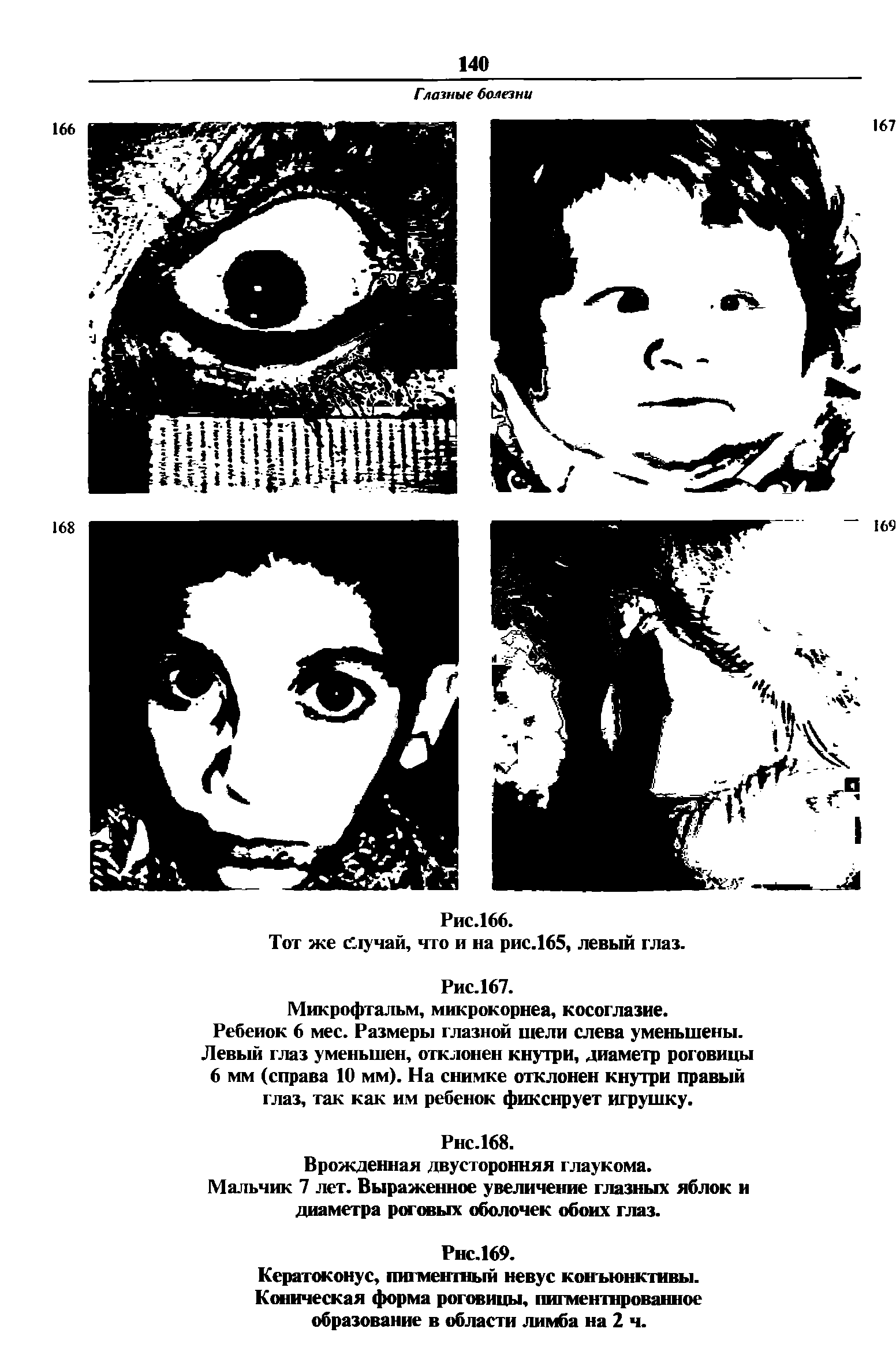 Рис.167. Микрофтальм, микрокорнеа, косоглазие. Ребенок 6 мес. Размеры глазной шели слева уменьшены. Левый глаз уменьшен, отклонен кнутри, диаметр роговицы 6 мм (справа 10 мм). На снимке отклонен кнутри правый глаз, так как им ребенок фиксирует игрушку.