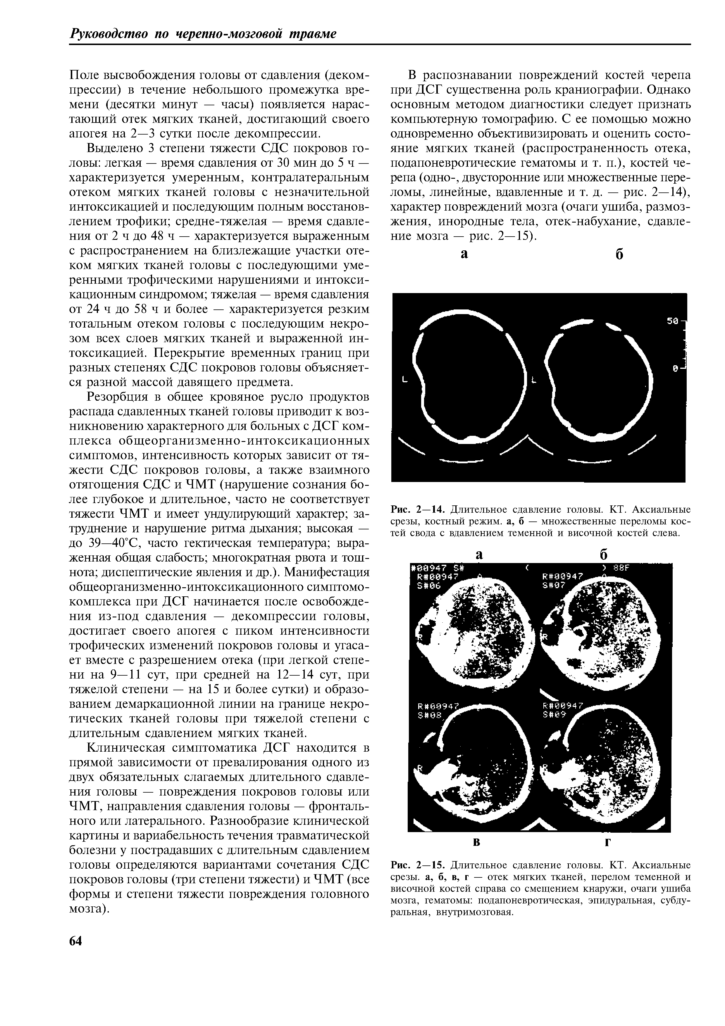 Рис. 2—15. Длительное сдавление головы. КТ. Аксиальные срезы, а, б, в, г — отек мягких тканей, перелом теменной и височной костей справа со смещением кнаружи, очаги ушиба мозга, гематомы подапоневротическая, эпидуральная, субдуральная, внутримозговая.