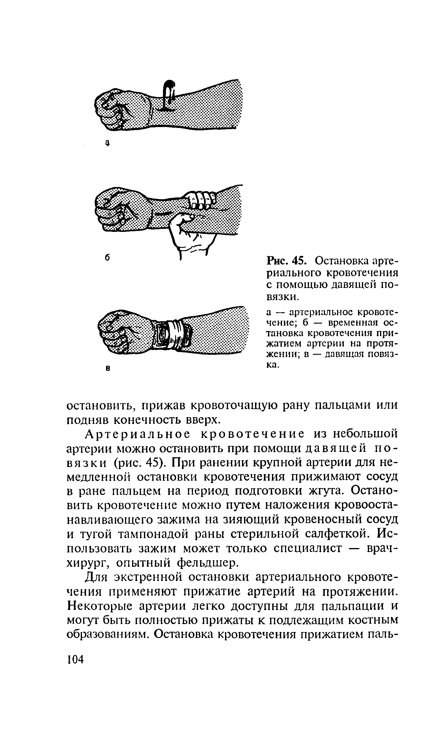 Рис. 45. Остановка артериального кровотечения с помощью давящей повязки.