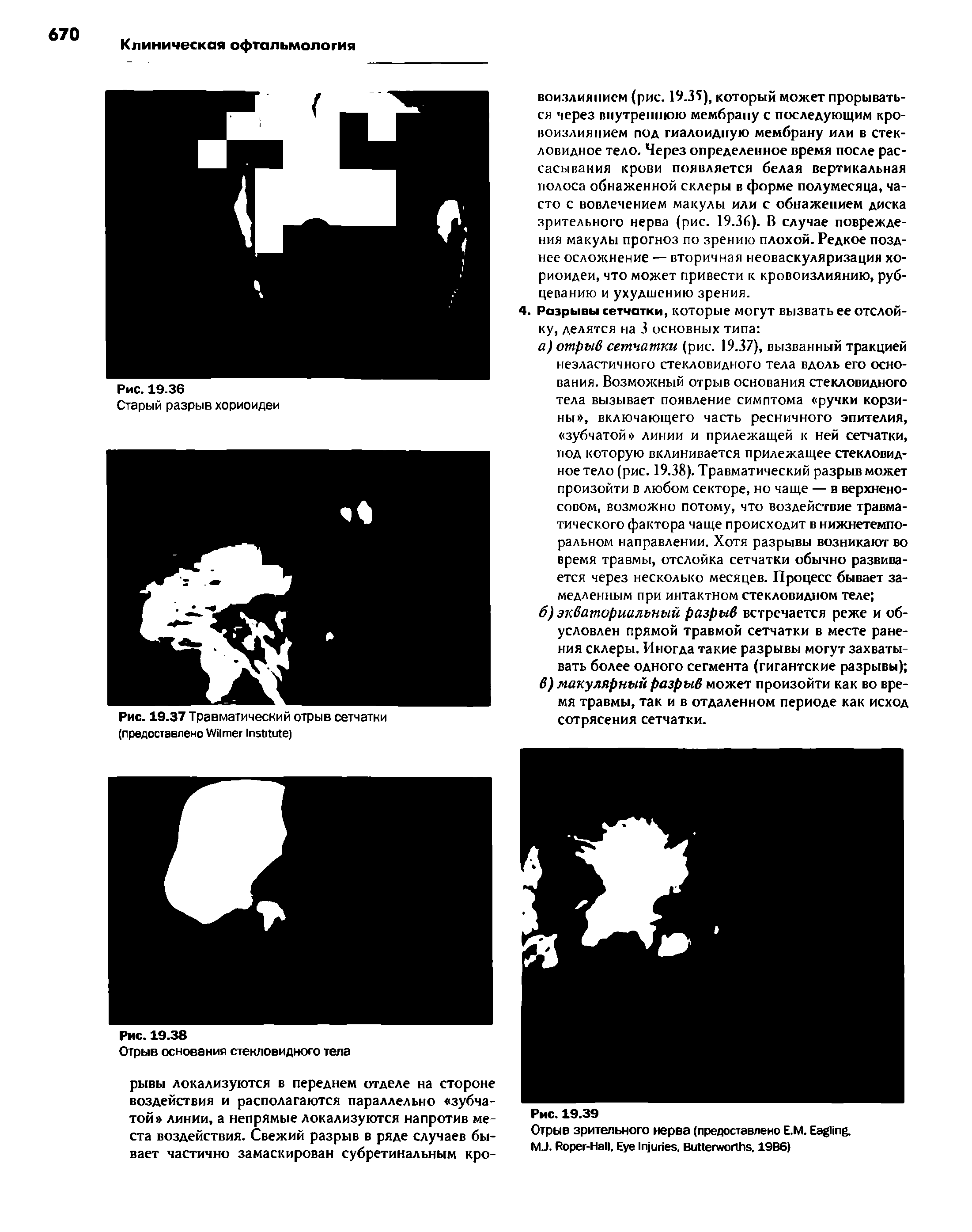 Рис. 19.37 Травматический отрыв сетчатки (предоставлено W I )...