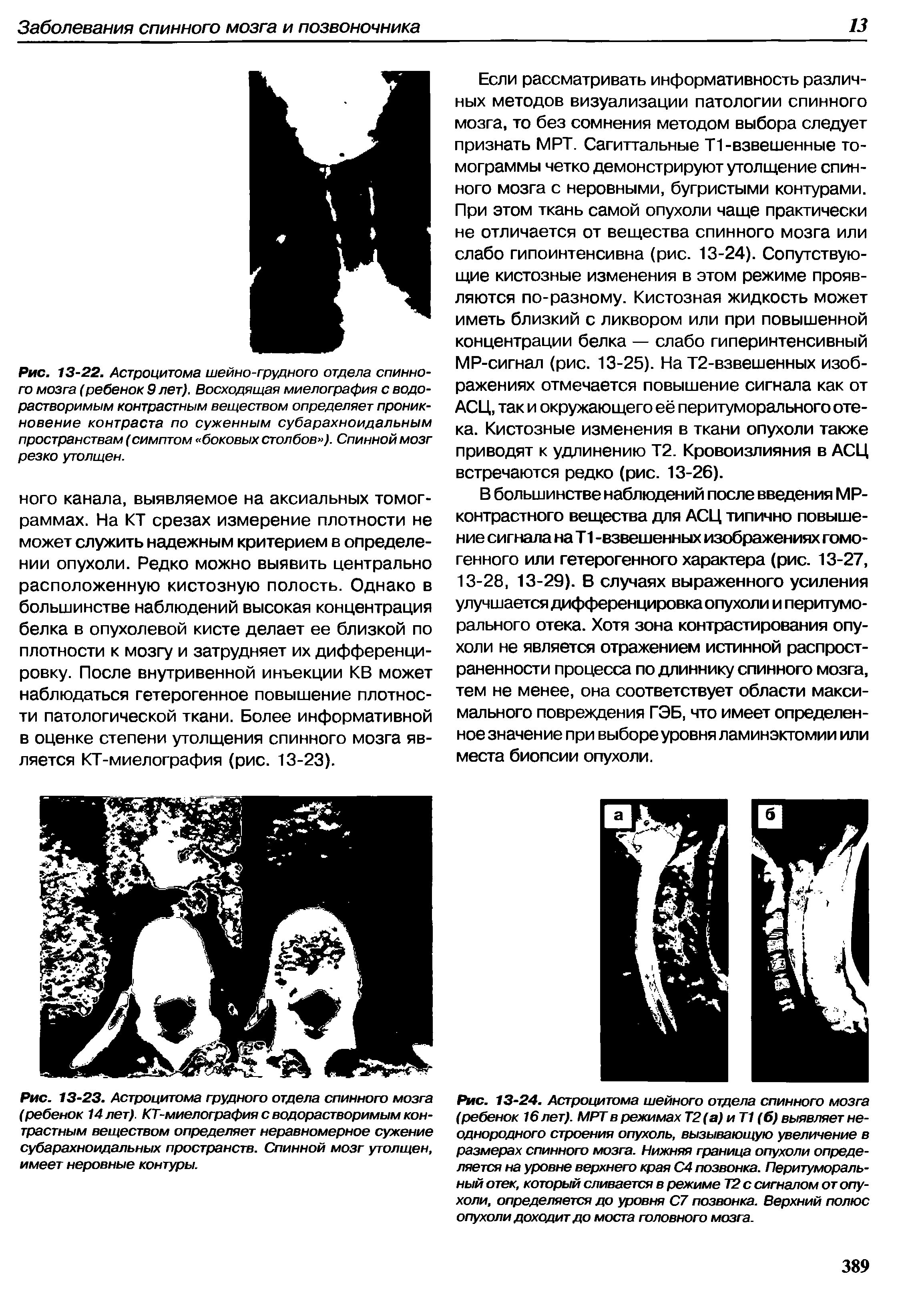 Рис. 13-23. Астроцитома грудного отдела спинного мозга (ребенок 14 лет). КТ-миелография с водорастворимым контрастным веществом определяет неравномерное сужение субарахноидальных пространств. Спинной мозг утолщен, имеет неровные контуры.