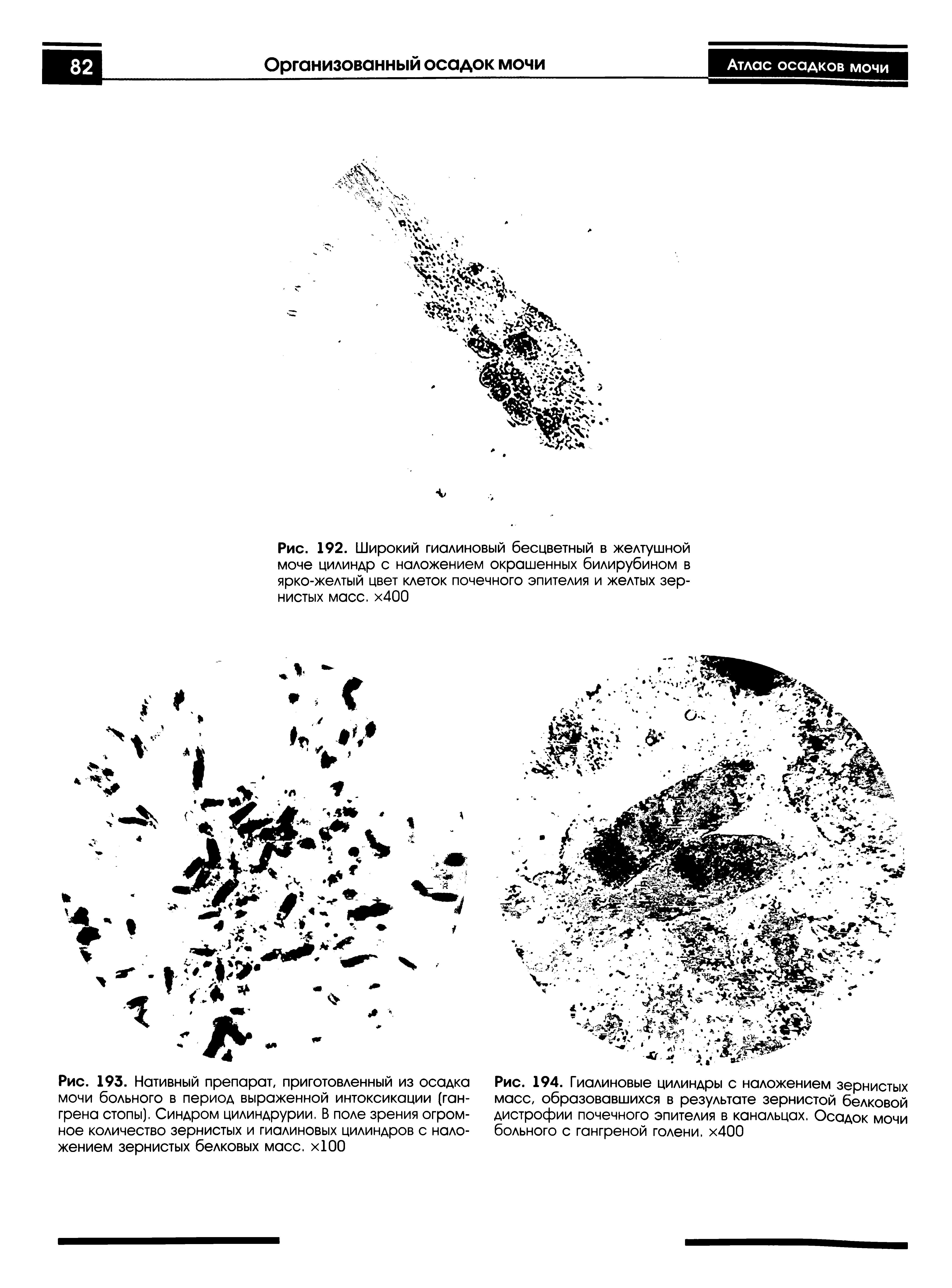 Рис. 192. Широкий гиалиновый бесцветный в желтушной моче цилиндр с наложением окрашенных билирубином в ярко-желтый цвет клеток почечного эпителия и желтых зернистых масс. х400...