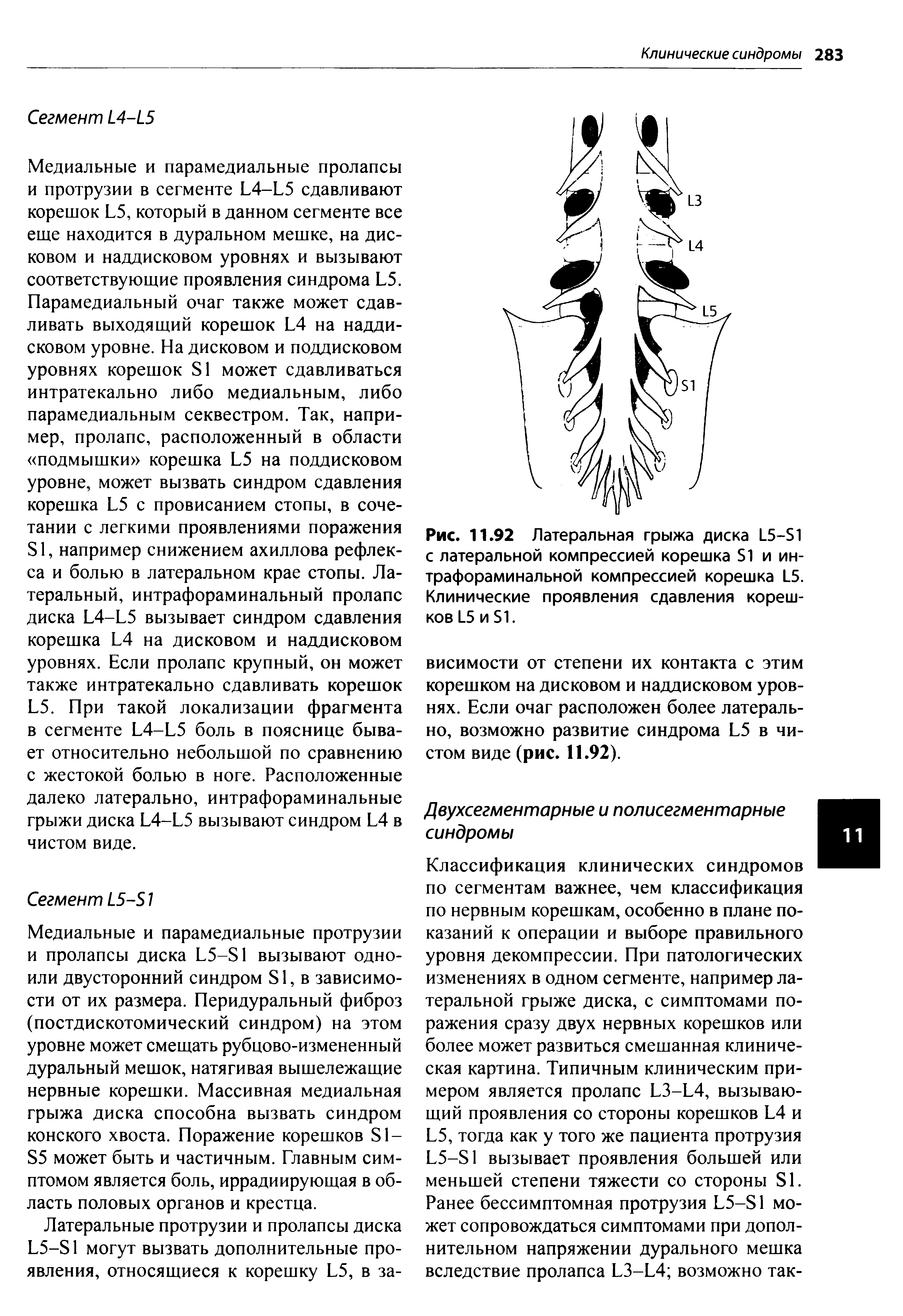 Рис. 11.92 Латеральная грыжа диска 1 5—Б1 с латеральной компрессией корешка и ин-трафораминальной компрессией корешка 1 5. Клинические проявления сдавления корешков 5 и Б1.
