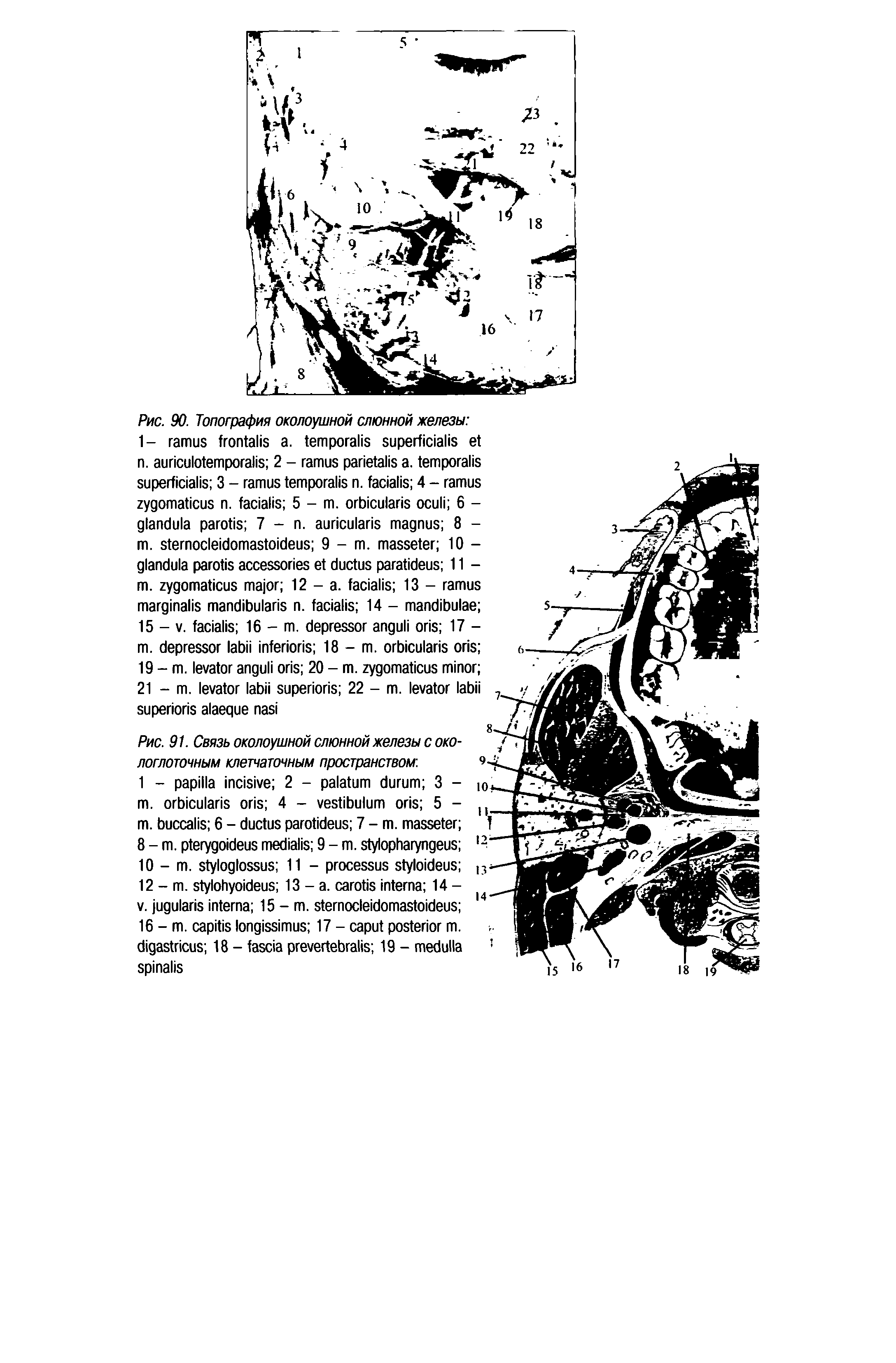 Рис. 91. Связь околоушной слюнной железы с окологлоточным клетчаточным пространством. ...