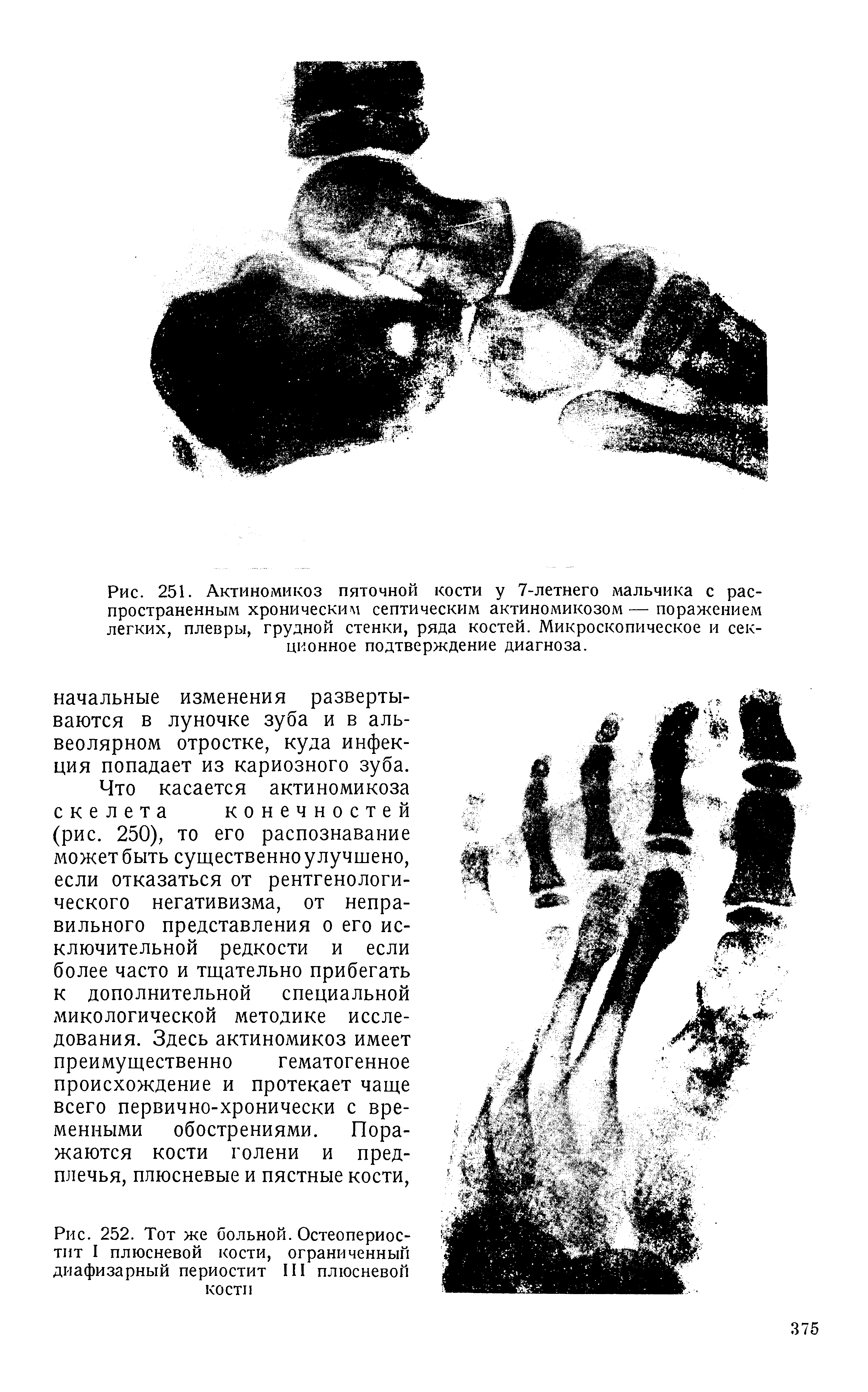 Рис. 252. Тот же больной. Остеопериостит I плюсневой кости, ограниченный диафизарный периостит III плюсневой кости...