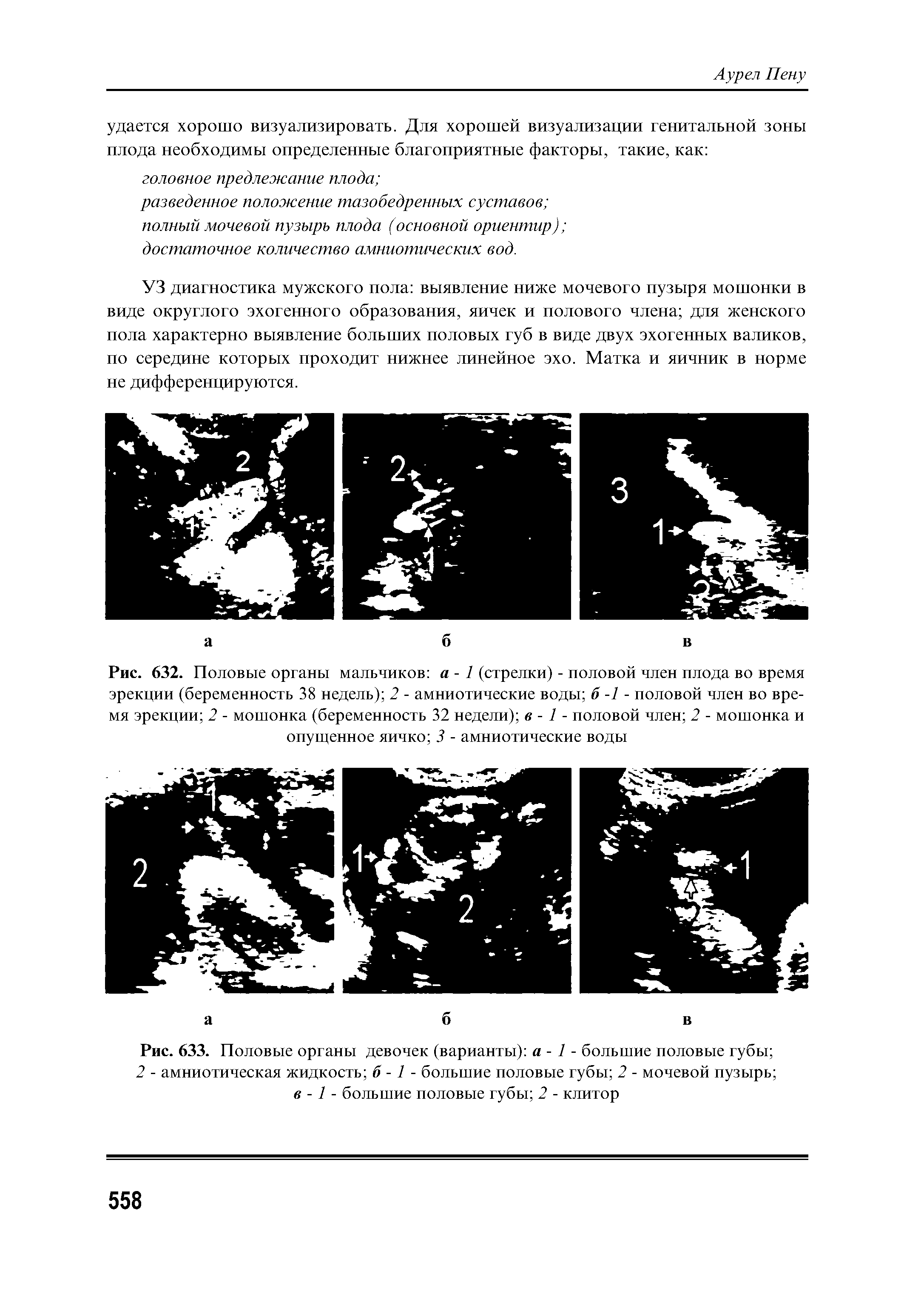 Рис. 632. Половые органы мальчиков а - 1 (стрелки) - половой член плода во время эрекции (беременность 38 недель) 2 - амниотические воды б -1 - половой член во время эрекции 2 - мошонка (беременность 32 недели) в - 1 - половой член 2 - мошонка и опущенное яичко 3 - амниотические воды...