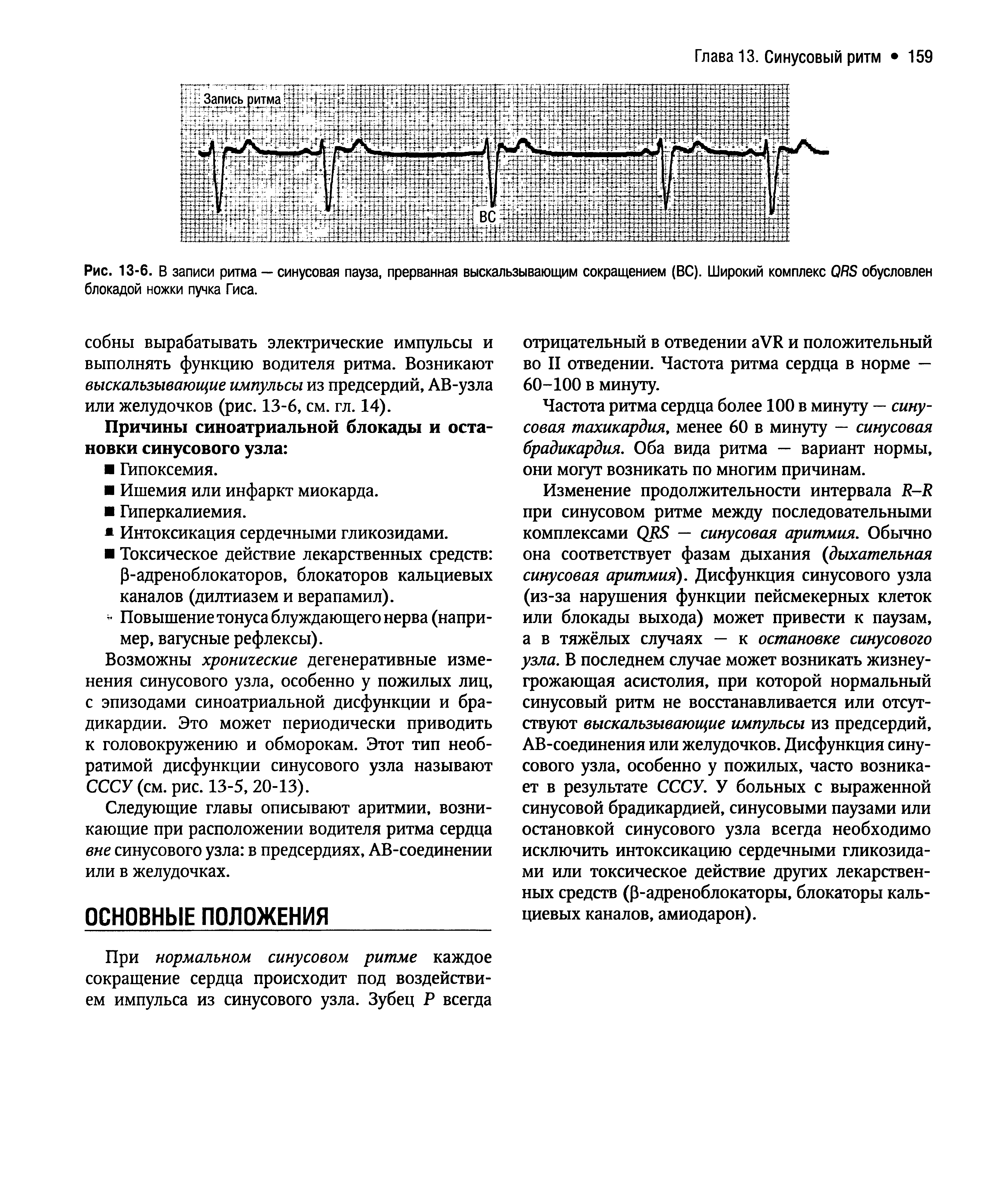 Рис. 13-6. В записи ритма — синусовая пауза, прерванная выскальзывающим сокращением (ВС). Широкий комплекс ОЯБ обусловлен блокадой ножки пучка Гиса.