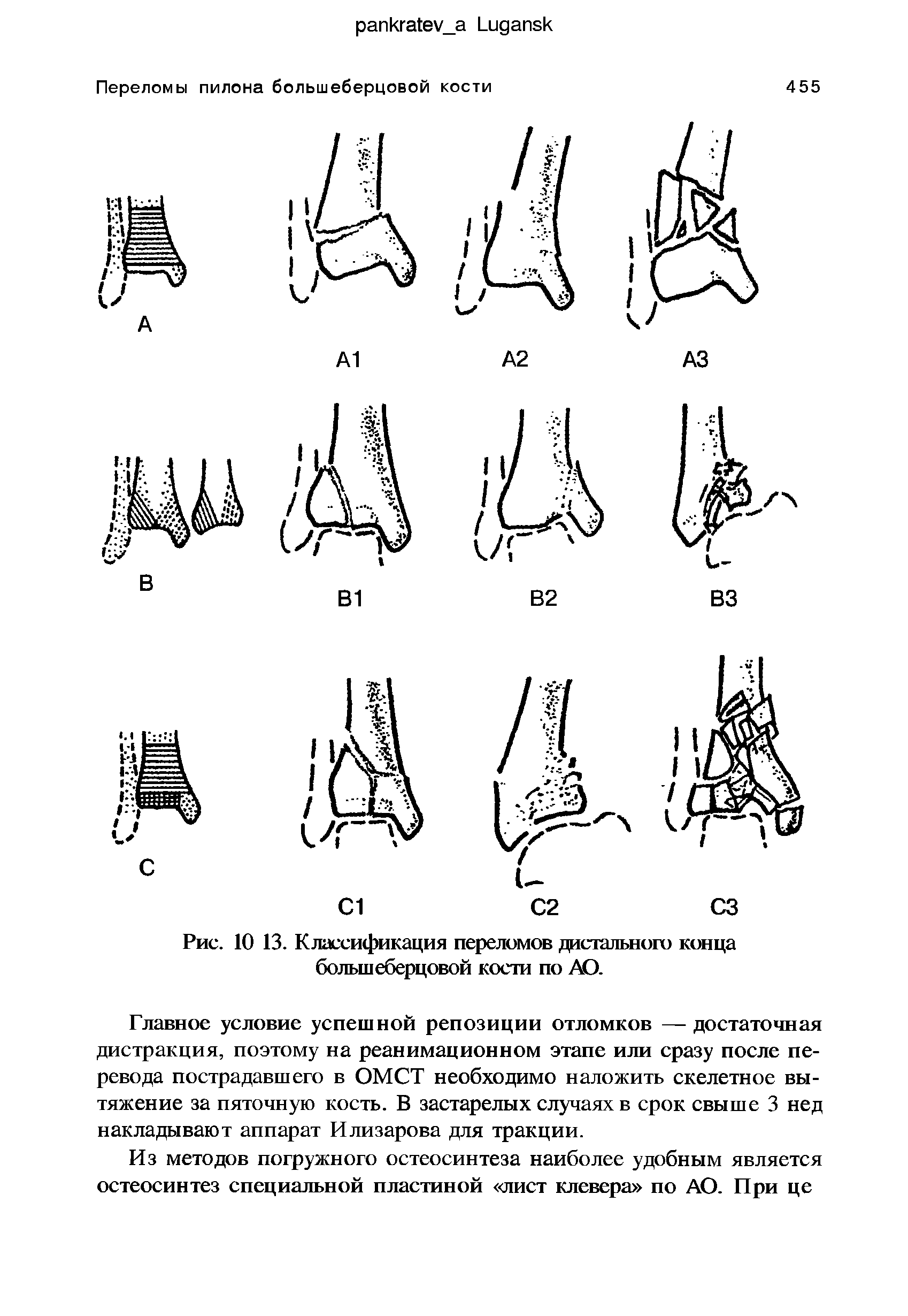 Рис. 10 13. Классификация переломов дистального конца большеберцовой кости по АО.